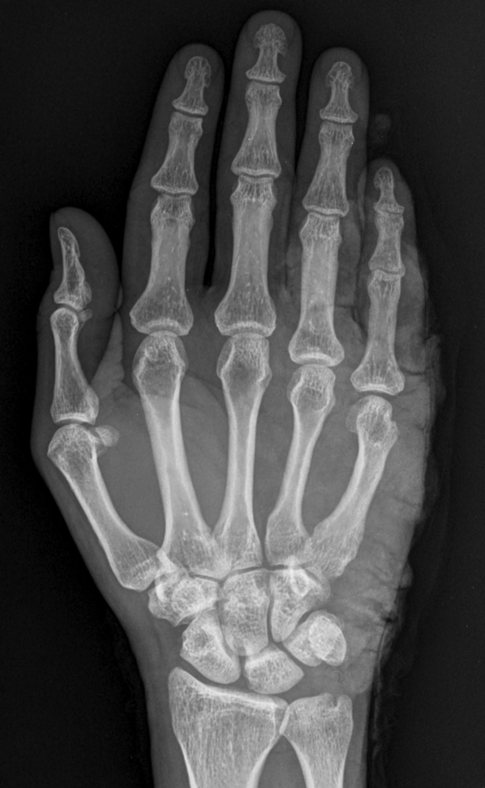 Carpal Tunnel Syndrome
