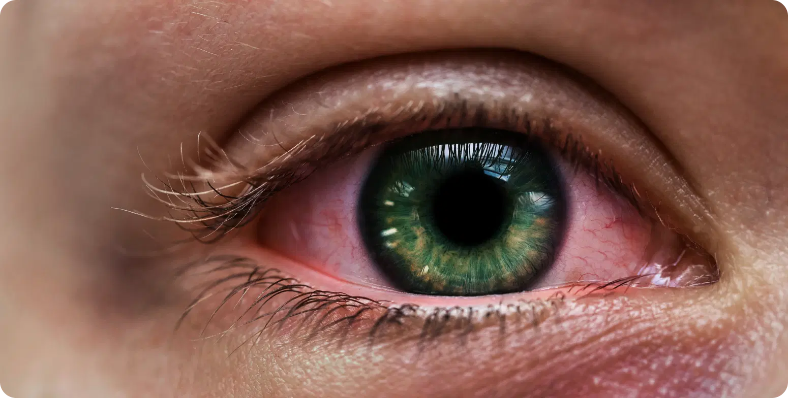 The Straits Times - Five ways to manage red eyes