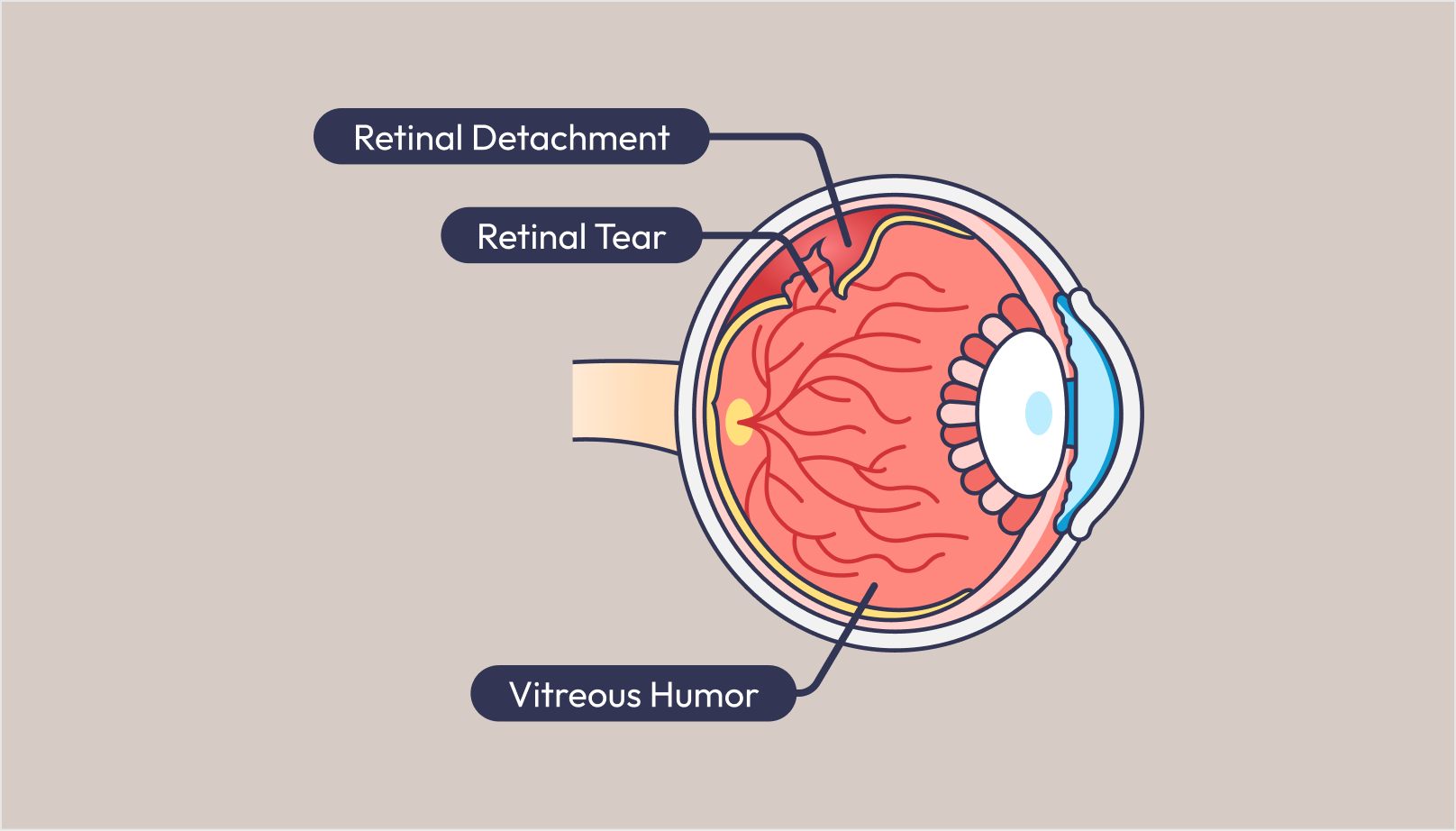 What is considered severe myopia? How does severe myopia contribute to retinal detachment?