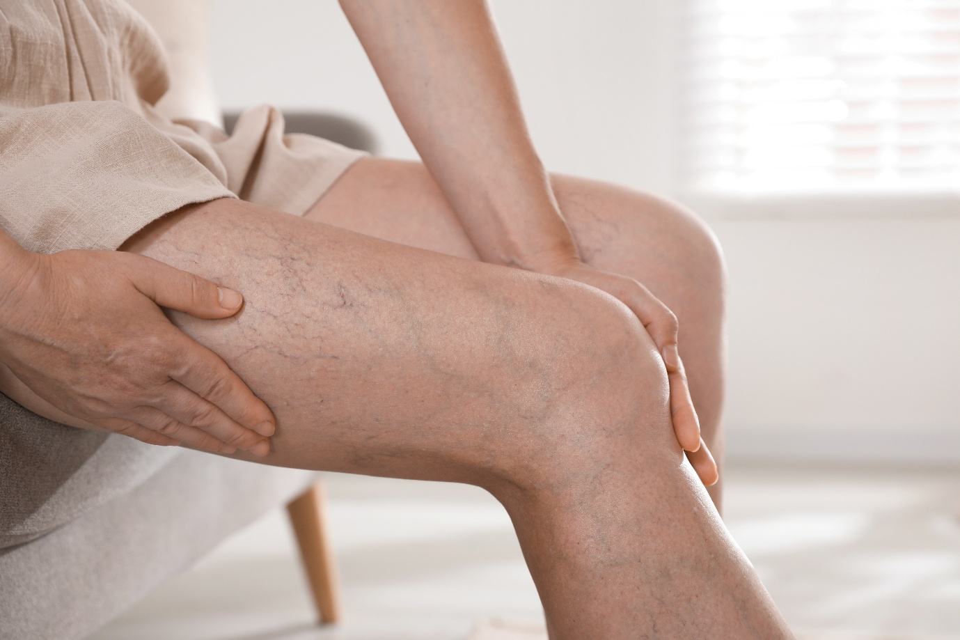 Do Varicose Veins Always Need Treatment?