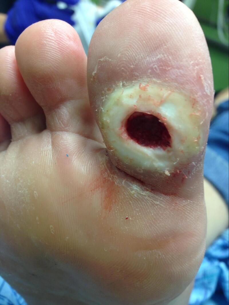 Klinisches Foto eines plantaren diabetischen Fußgeschwürs