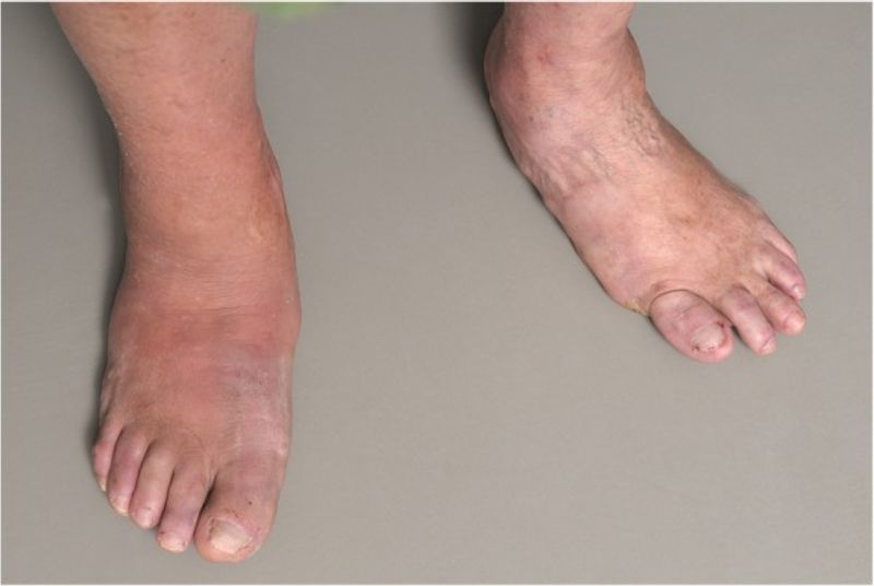 Akute aktive Phase des Charcot-Fußes mit Rötung, Schwellung und Überwärmung