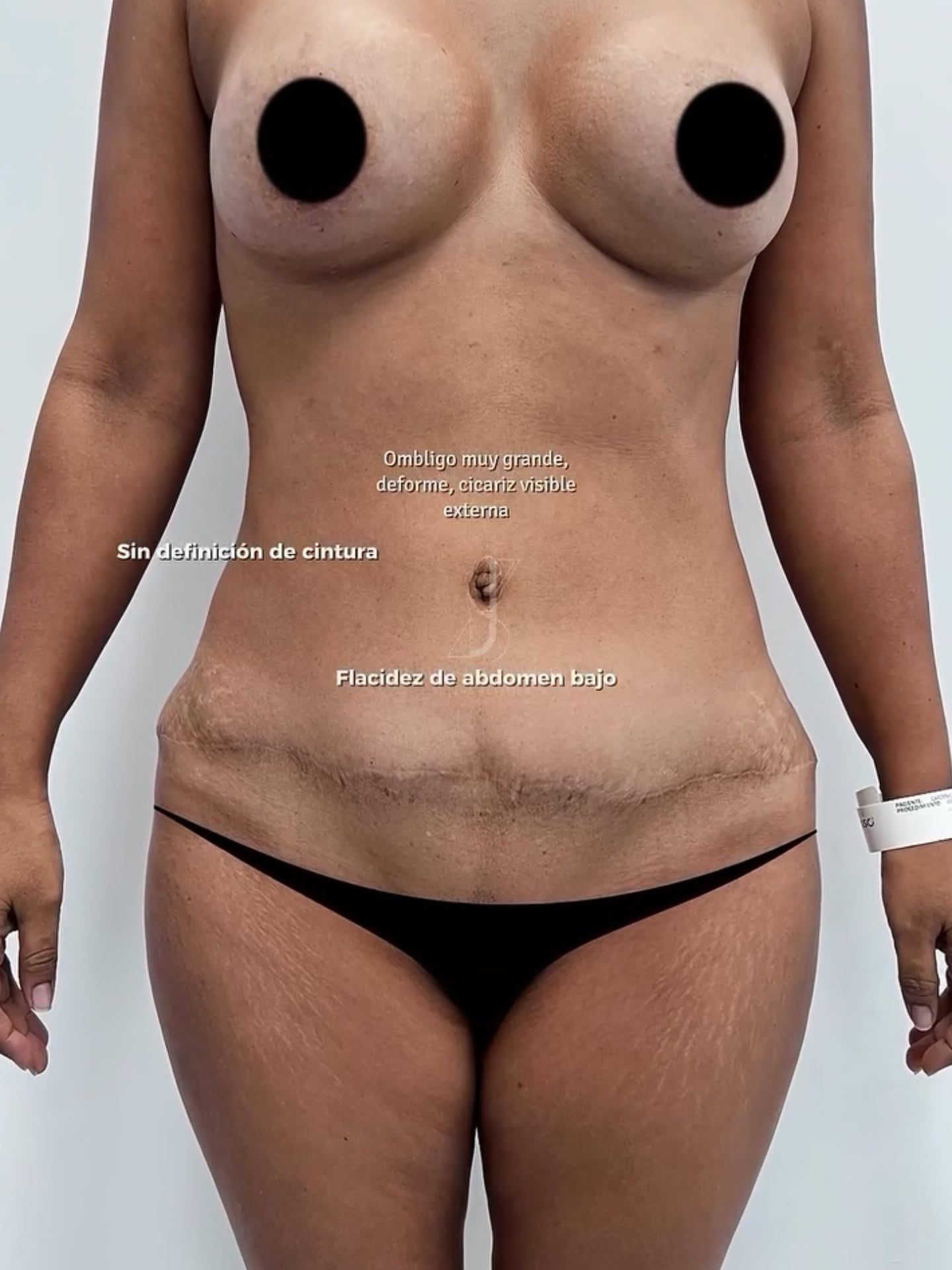 Lipoabdominoplastía