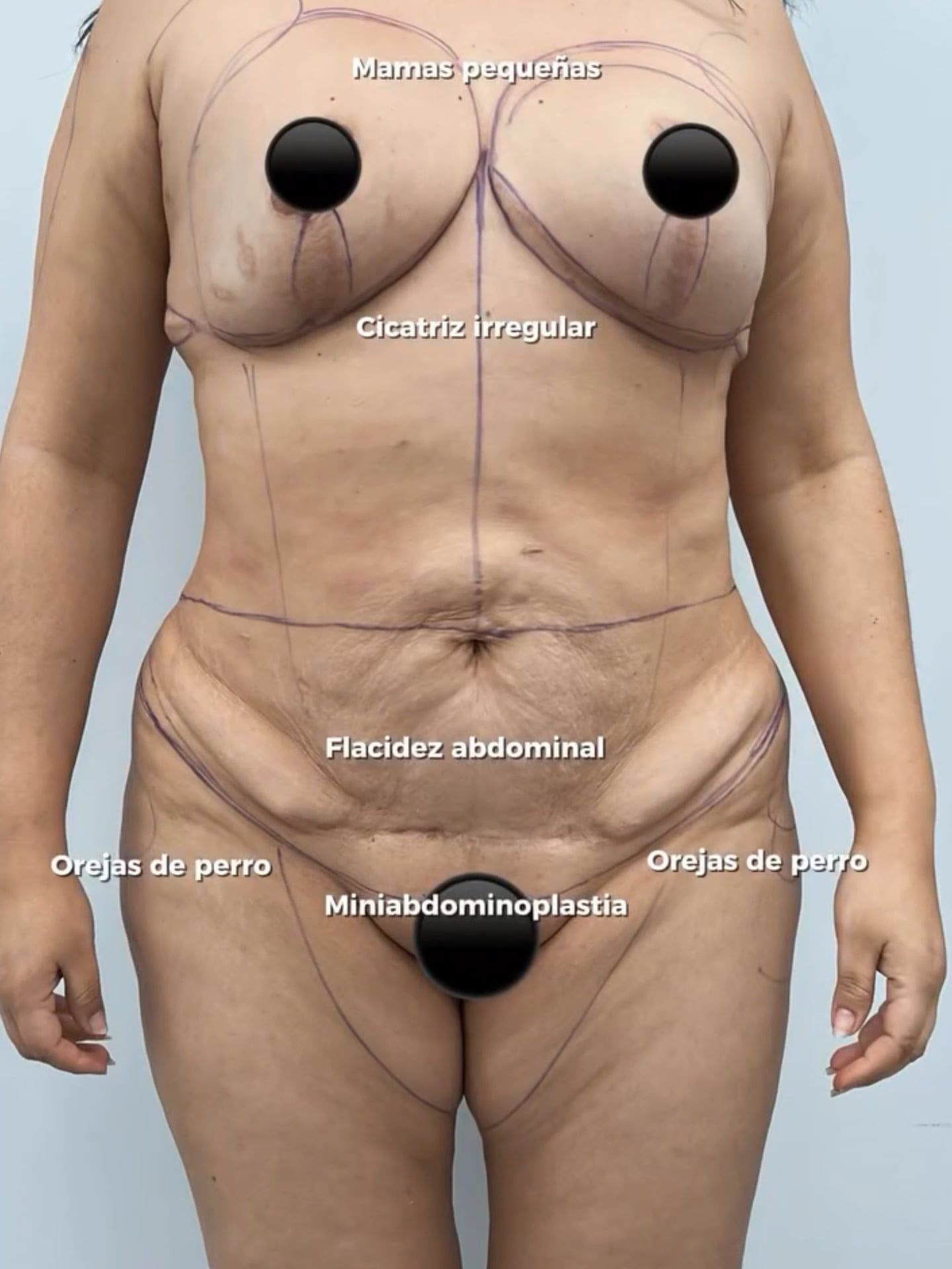 Lipoabdominoplastía.