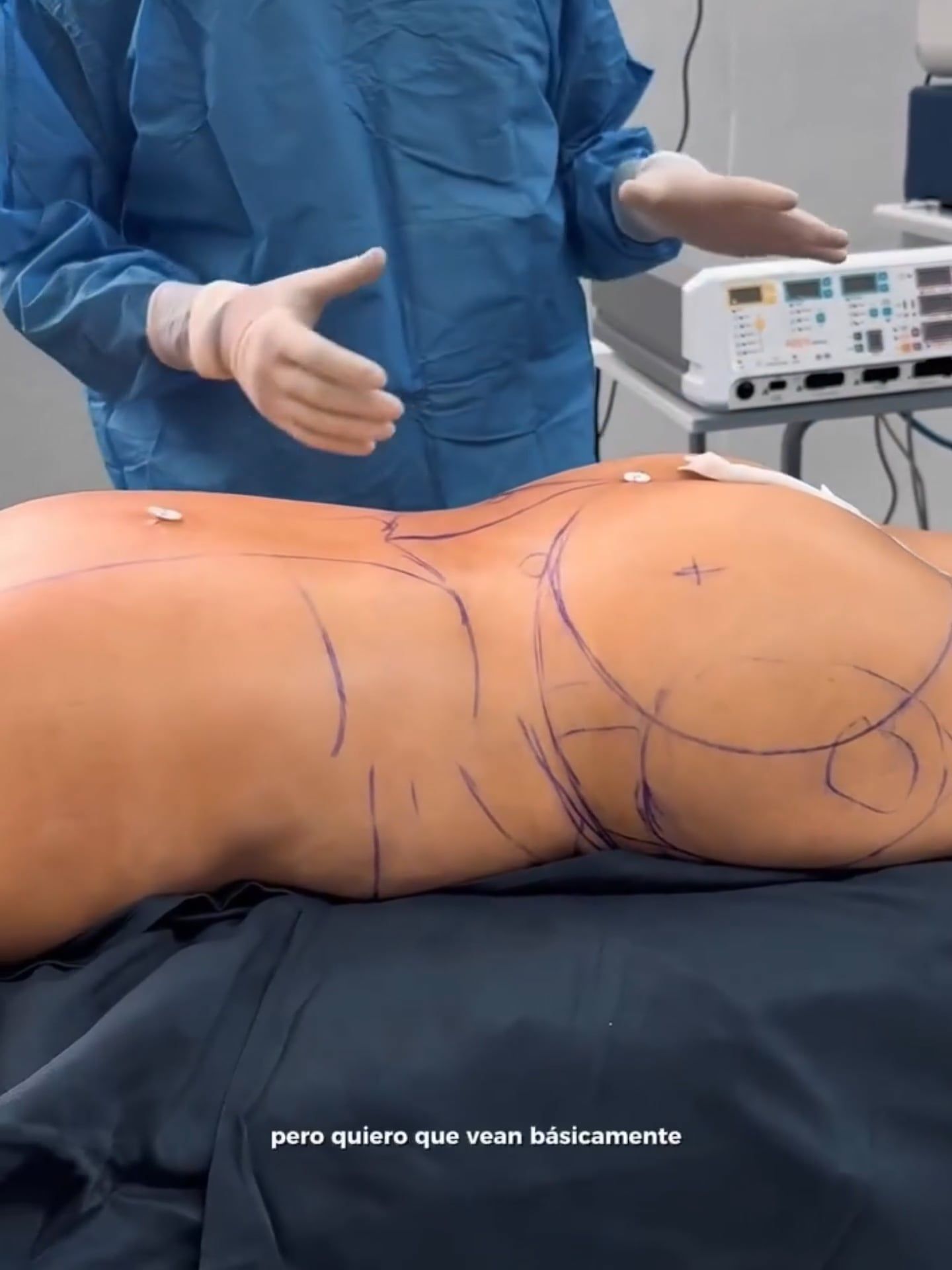 Lipoabdominoplastía.