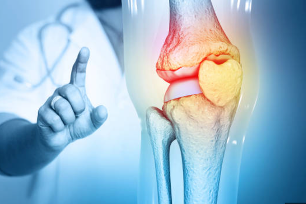 Osteoarthritis: Why Movement Is Medicine