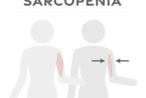 Sarcopenia: The Silent Muscle Loss After 60
