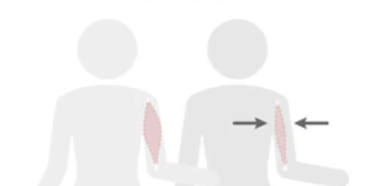 Sarcopenia: The Silent Muscle Loss After 60