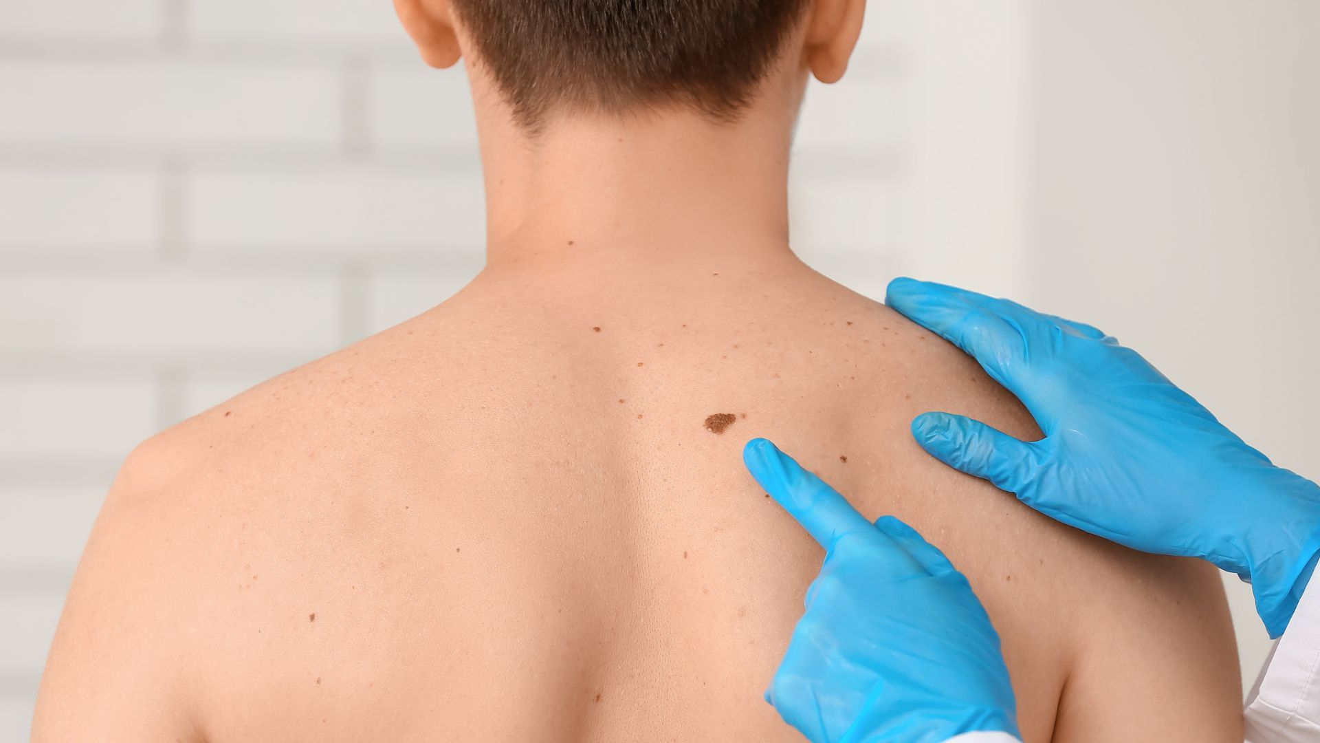 Alunițe și Leziuni Pigmentare