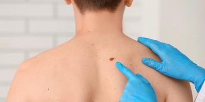 Alunițe și Leziuni Pigmentare