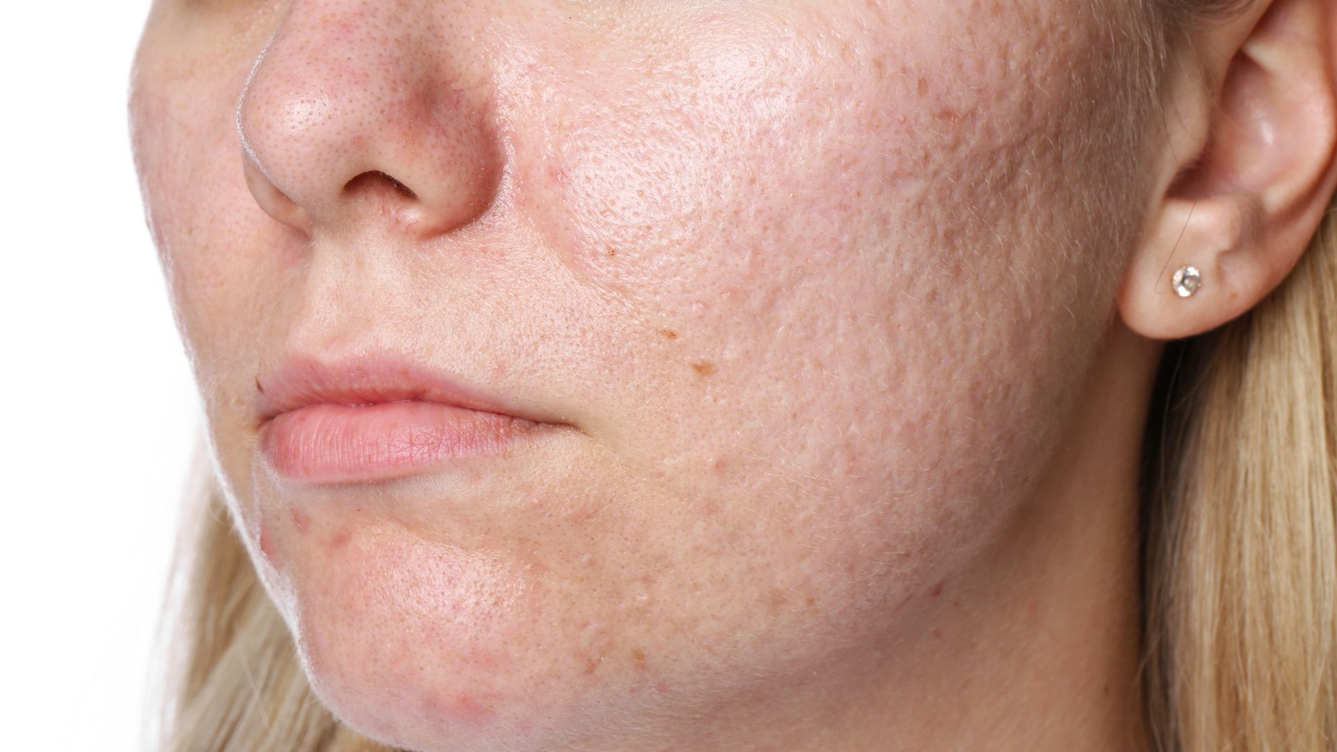 Cicatrici post-acneice