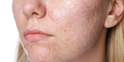 Cicatrici post-acneice