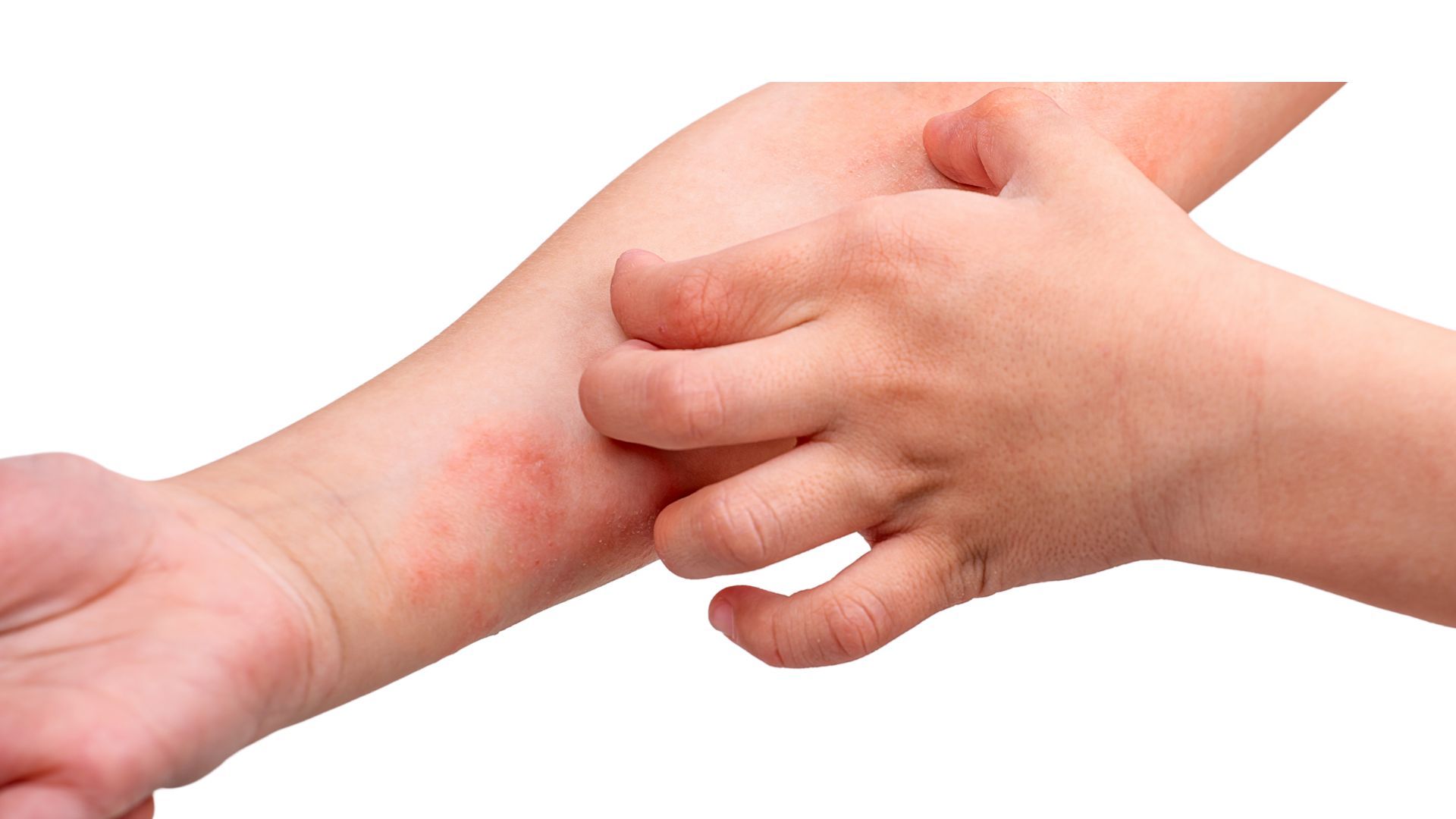 Eczeme și Dermatite