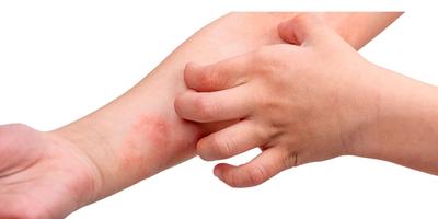 Eczeme și Dermatite