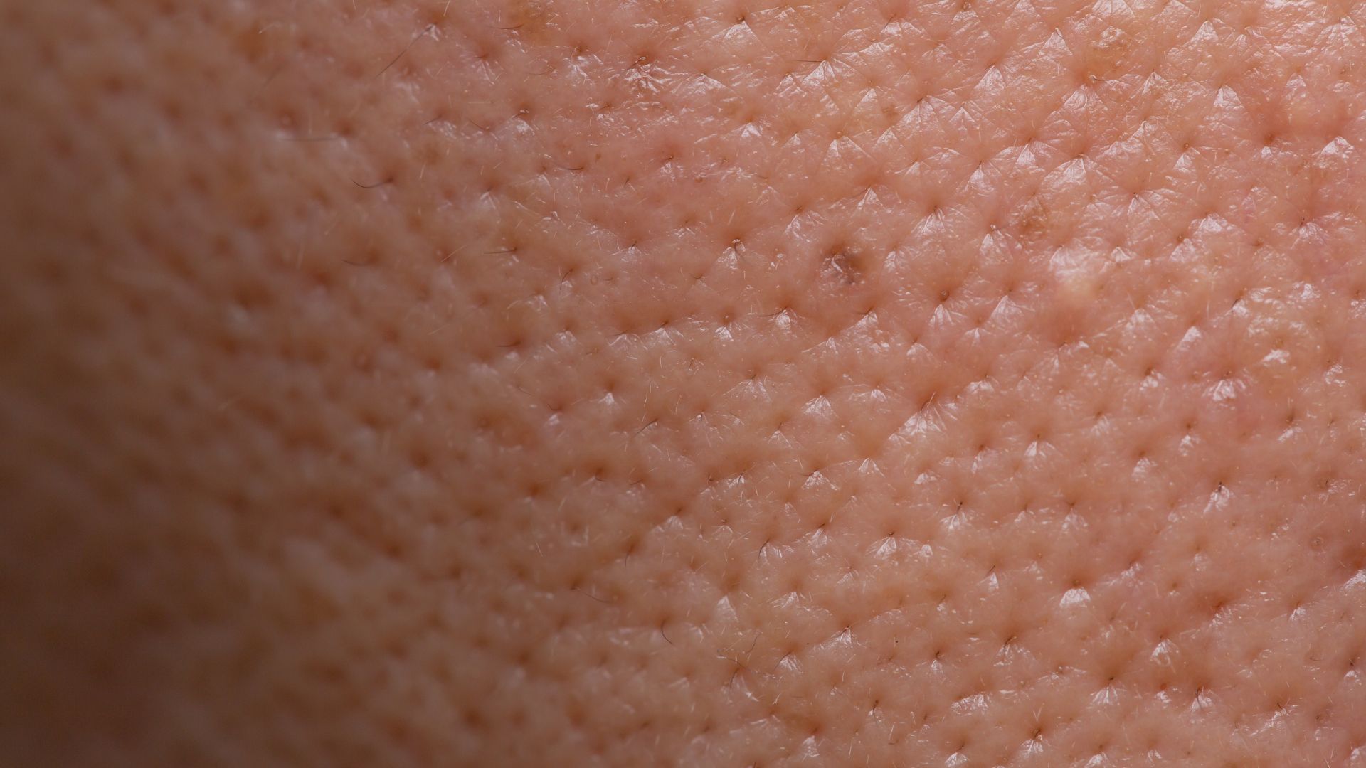 Tratament Pori Dilatați și Textură Neuniformă