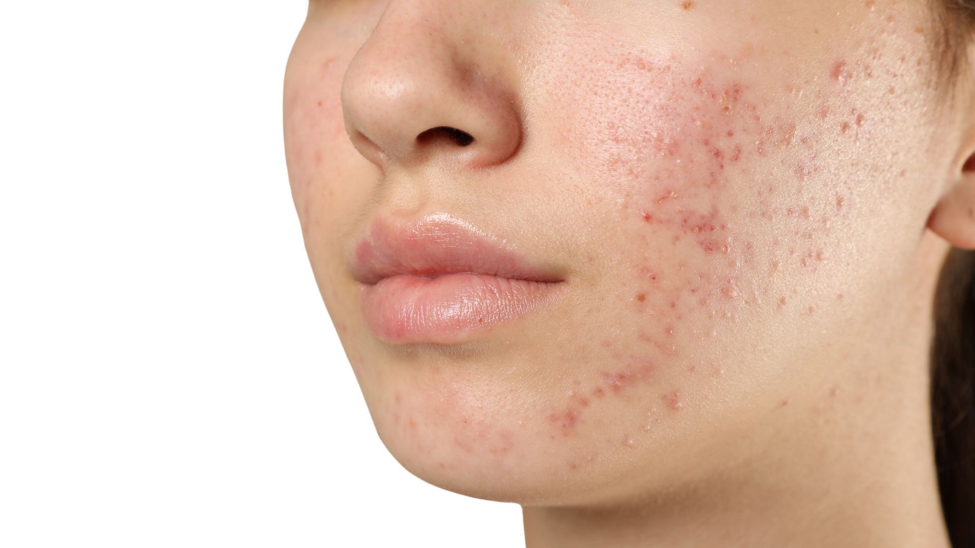 Tratament Acnee - Abordare Medicală Personalizată pentru Acnee - Adulți și Adolescenți