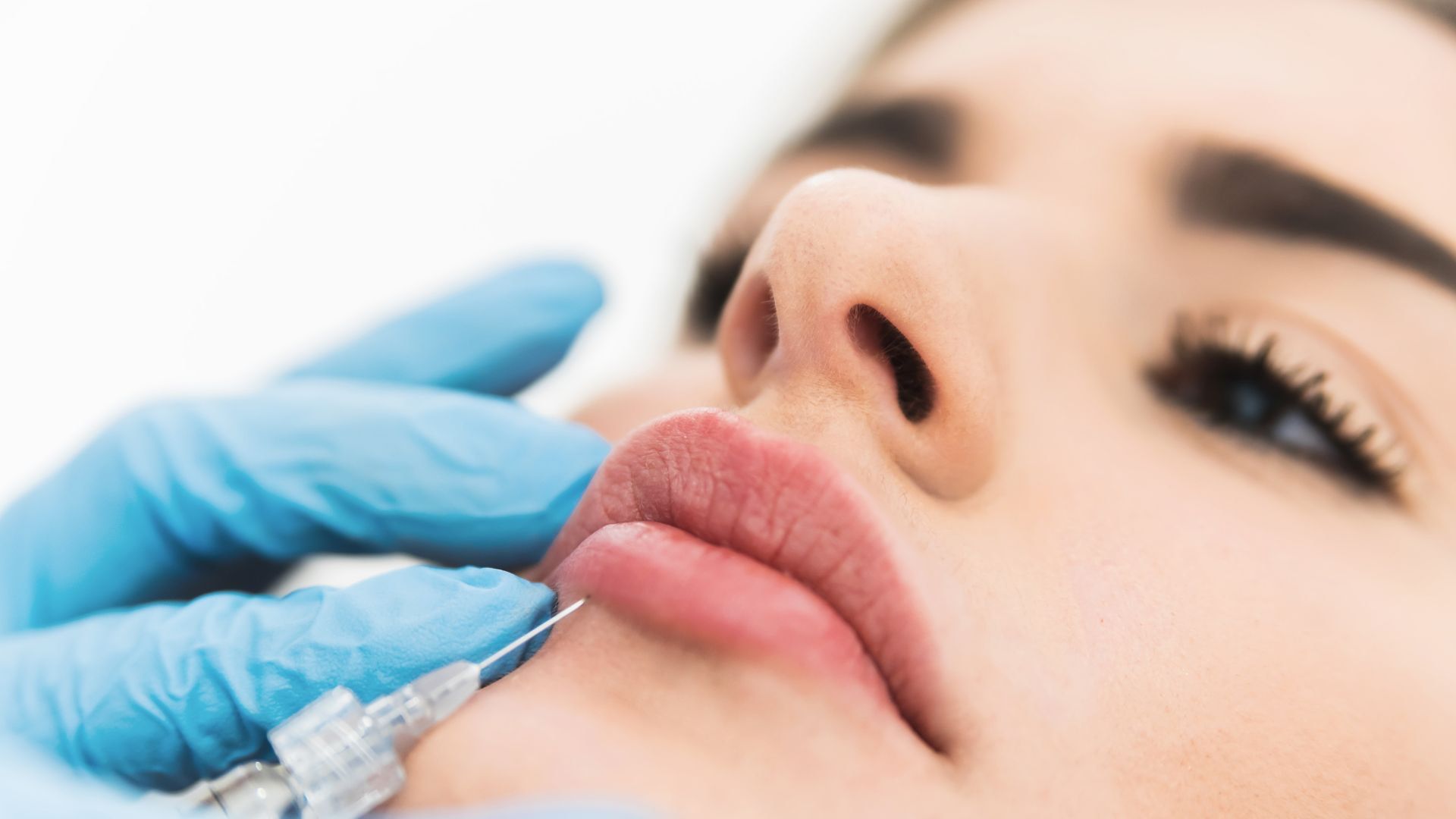 Augmentare Buze cu Acid Hialuronic - Volum Natural și Proporții Echilibrate