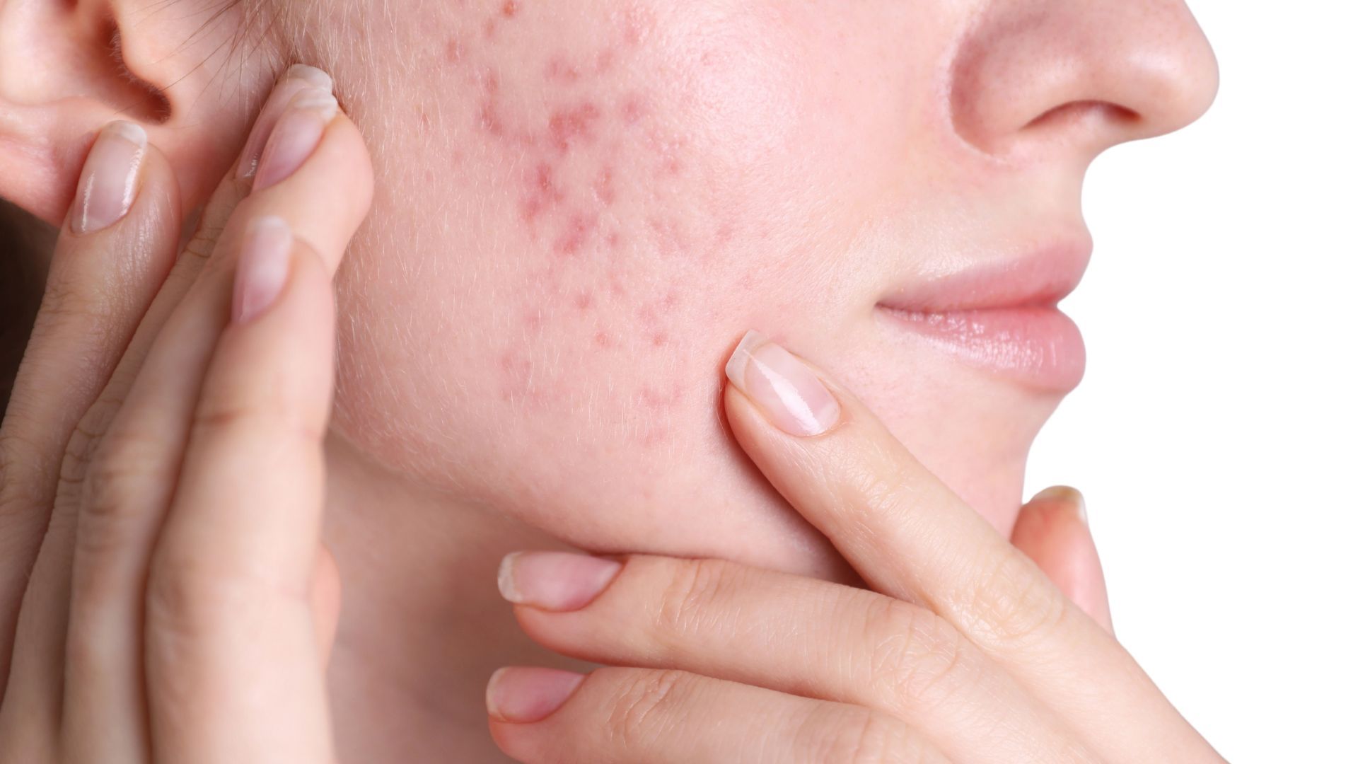 Tratament Cicatrici Postacneice (Cicatrici după Acnee – Laser și Microneedling)