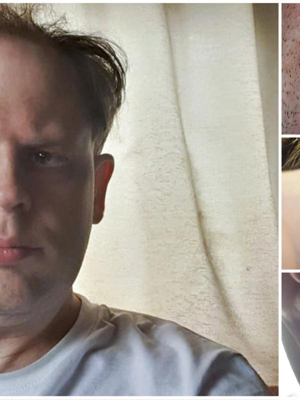 Lars Jensen får ikke plass hos offentlig tannlege og har ikke råd til privat.