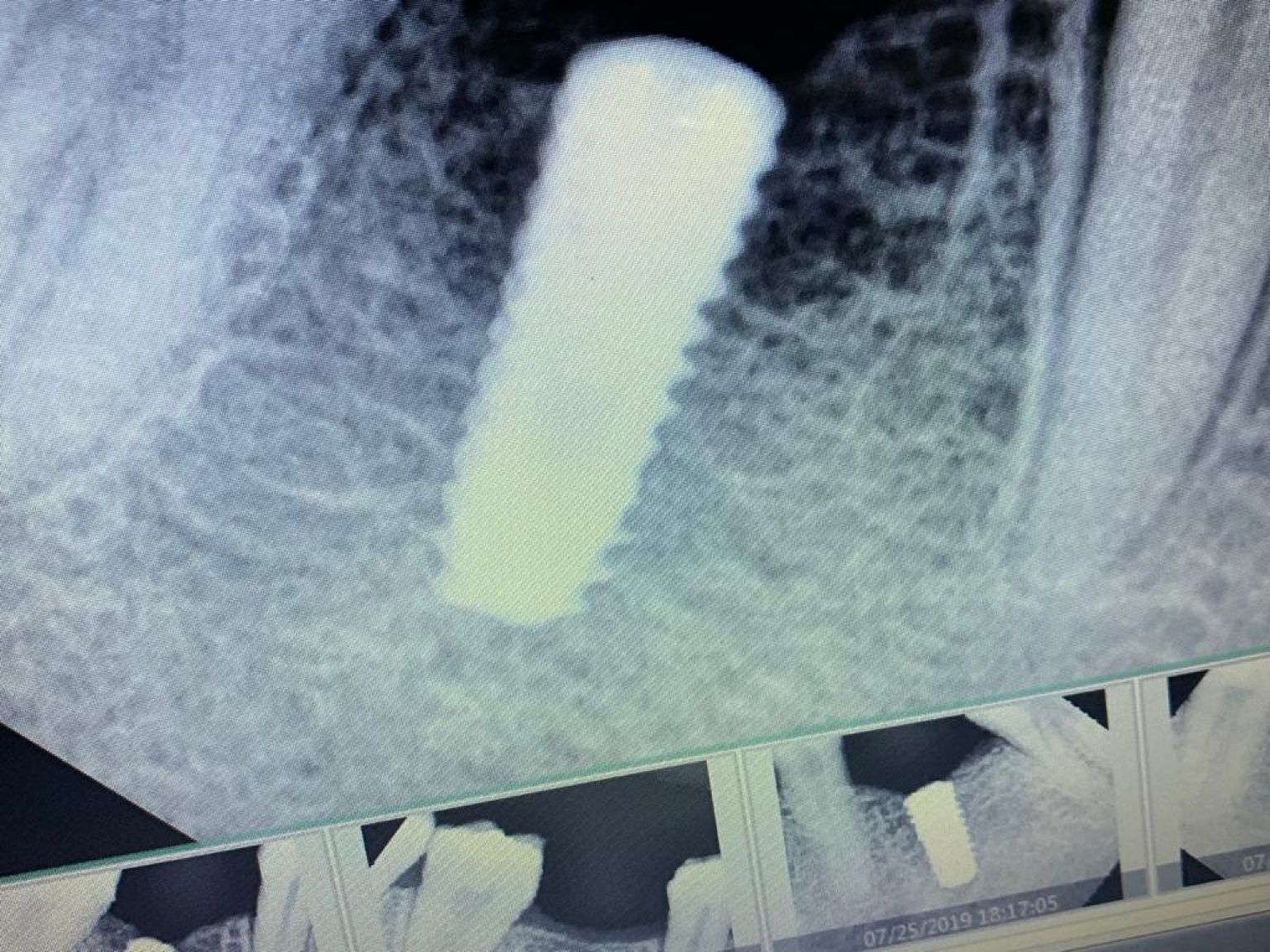 Implant image
