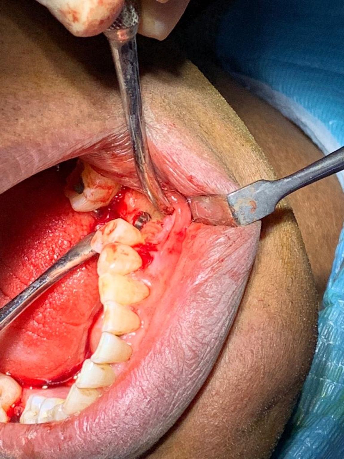 Implant image