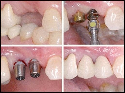 Implant image