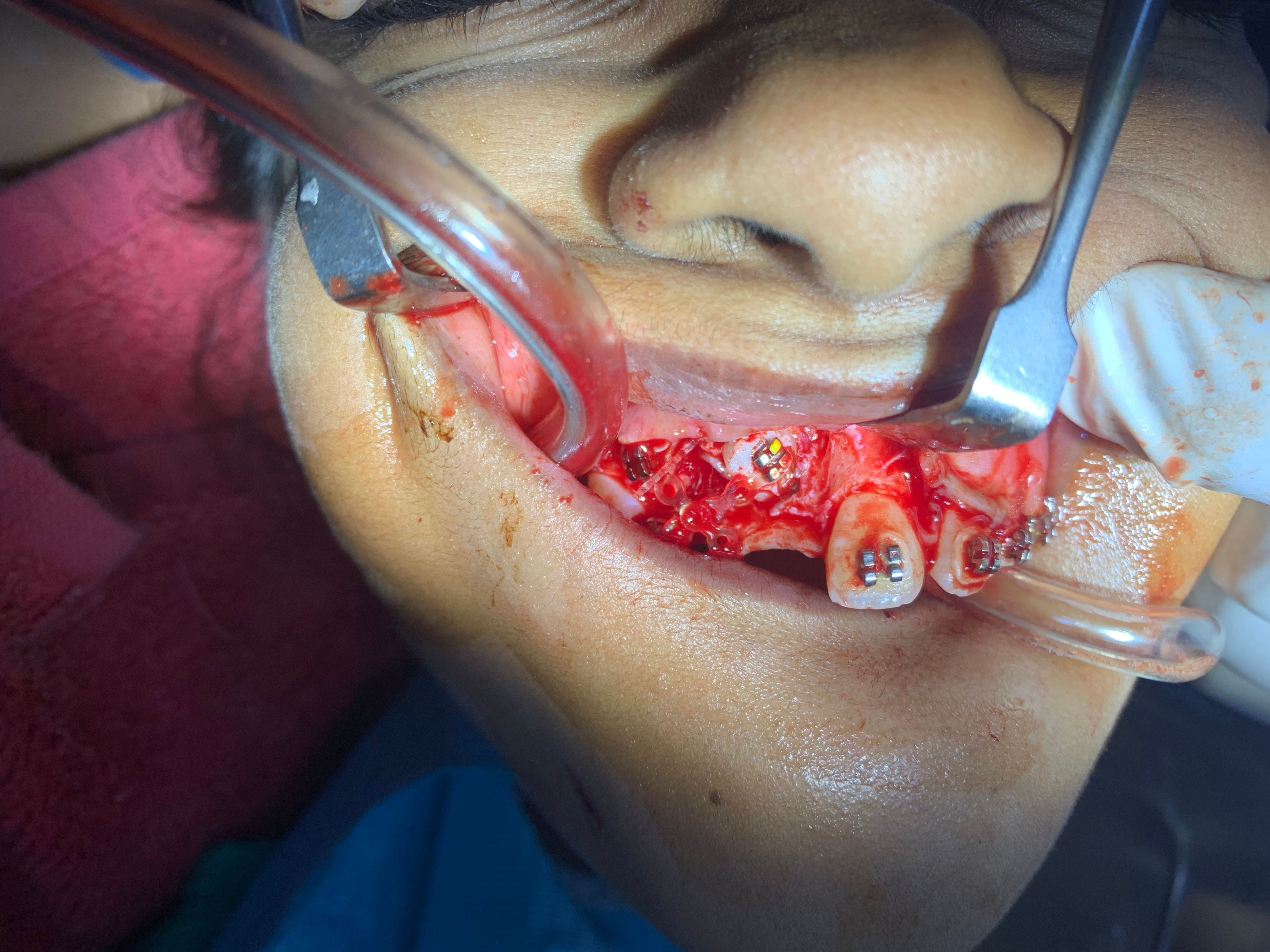 Orthodontic Treatment (Braces)