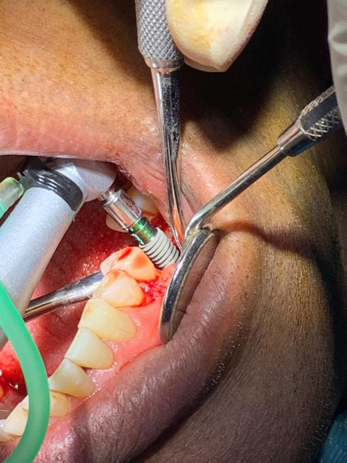 Implant image