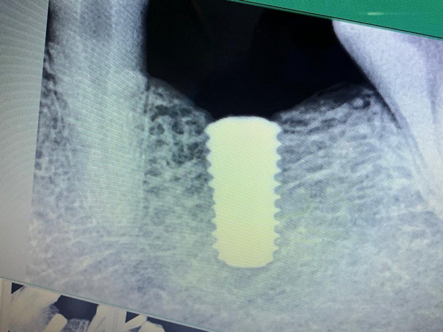 Implant image