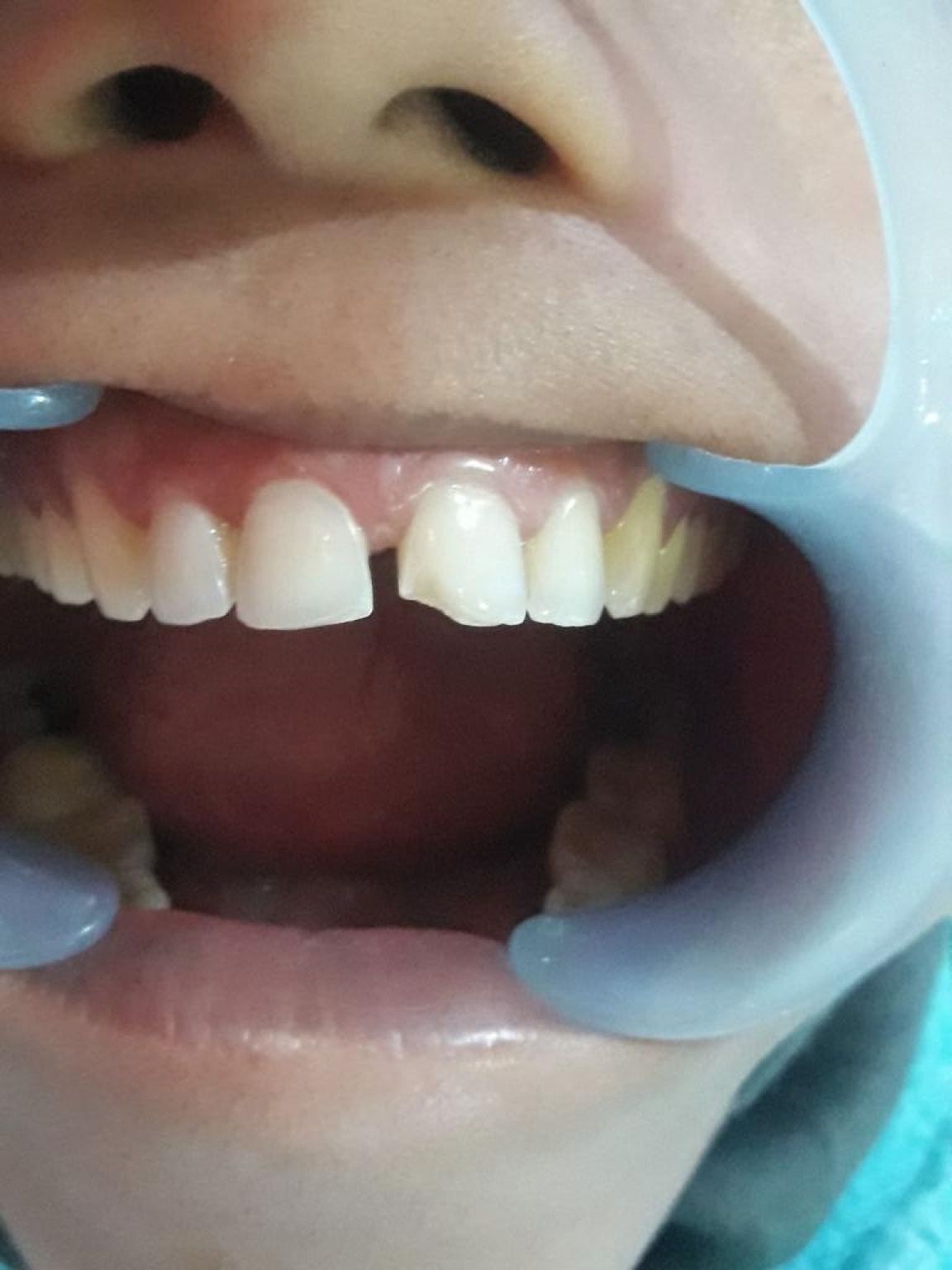 Dental Fillings