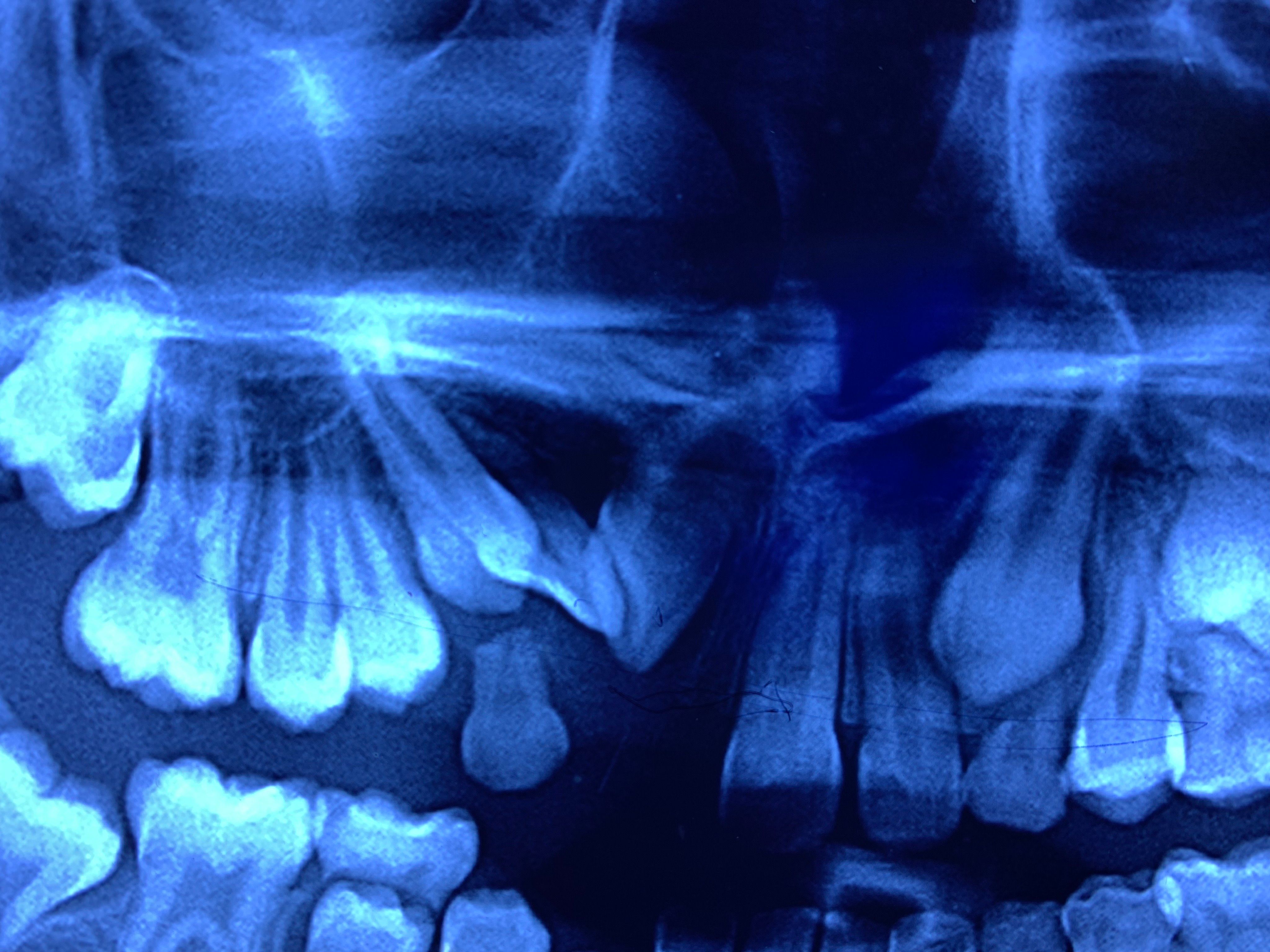 Orthodontic Treatment (Braces)
