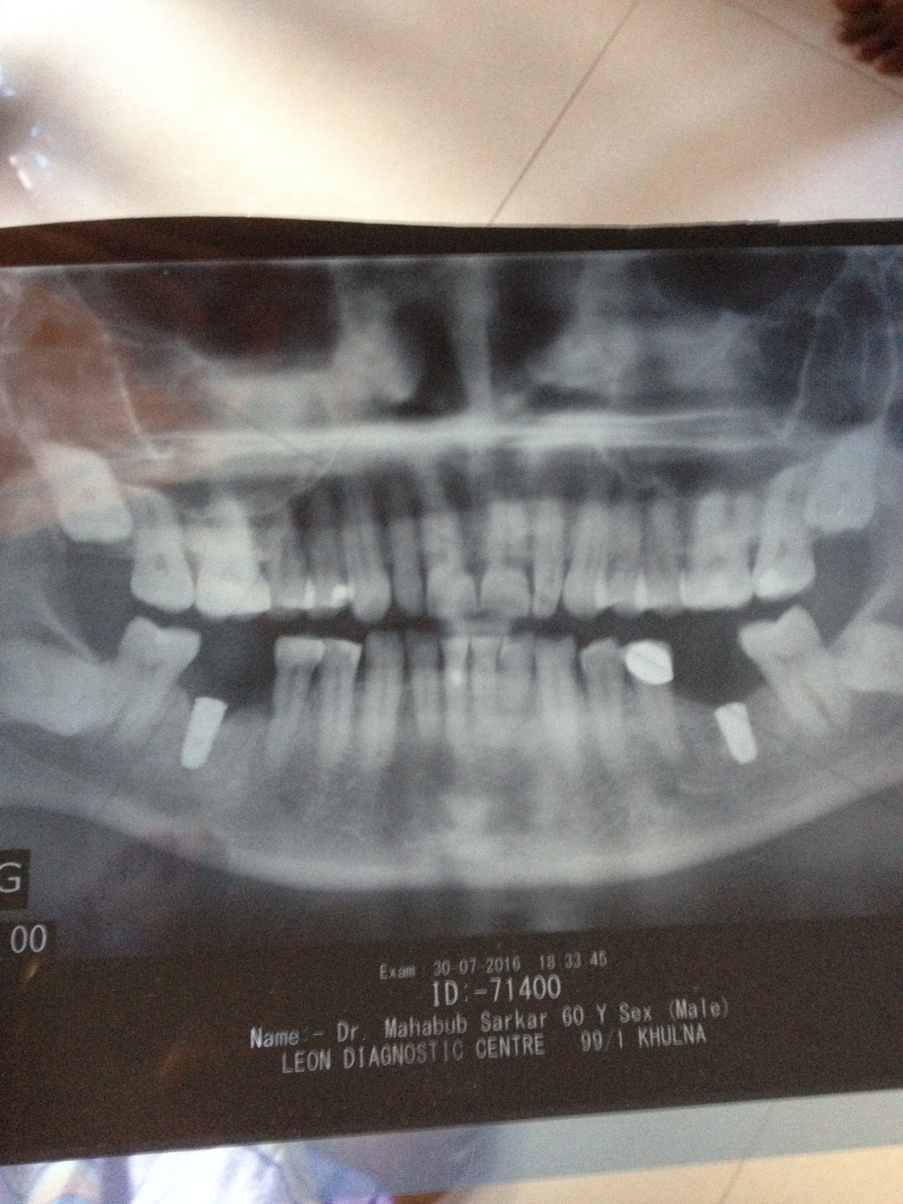 Dental Implant