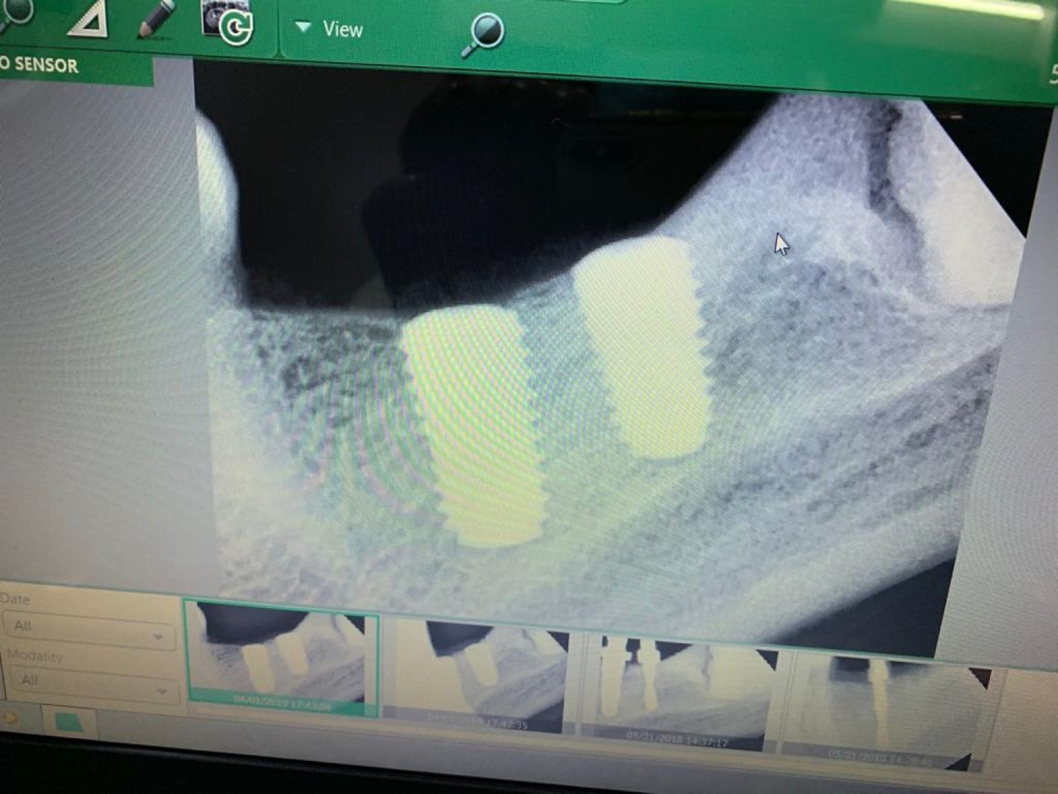Implant image
