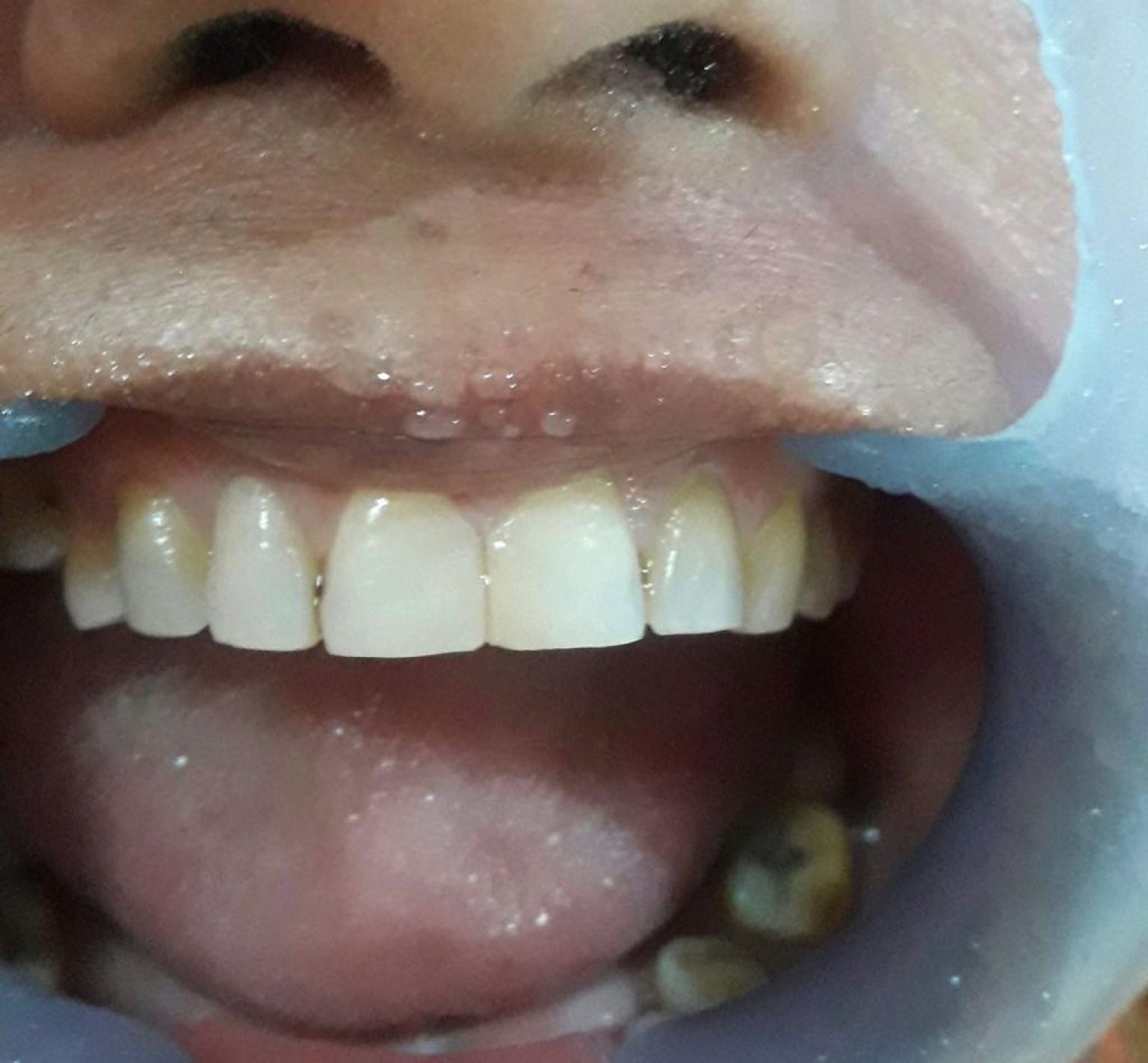 Dental Fillings