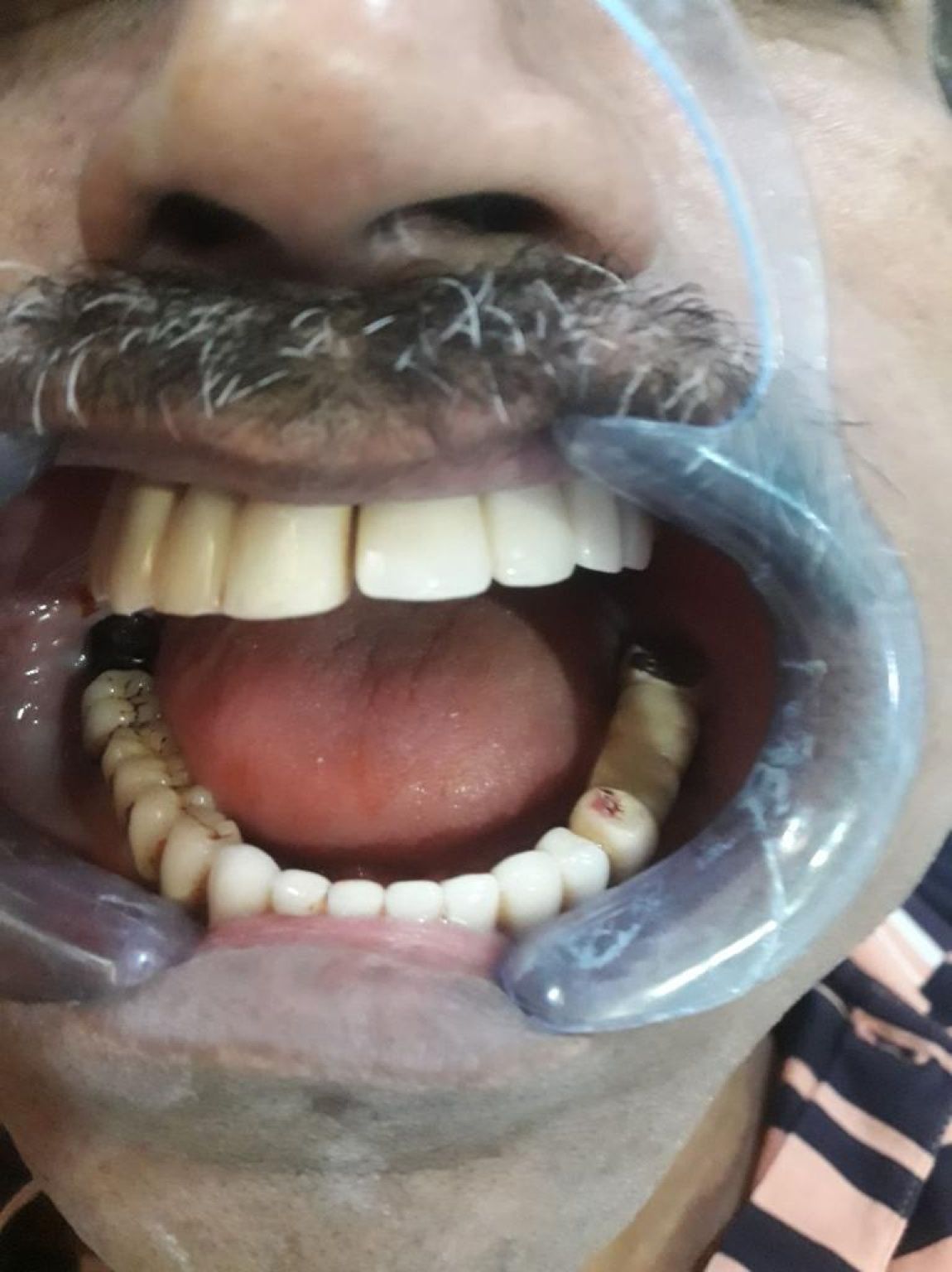 Implant image