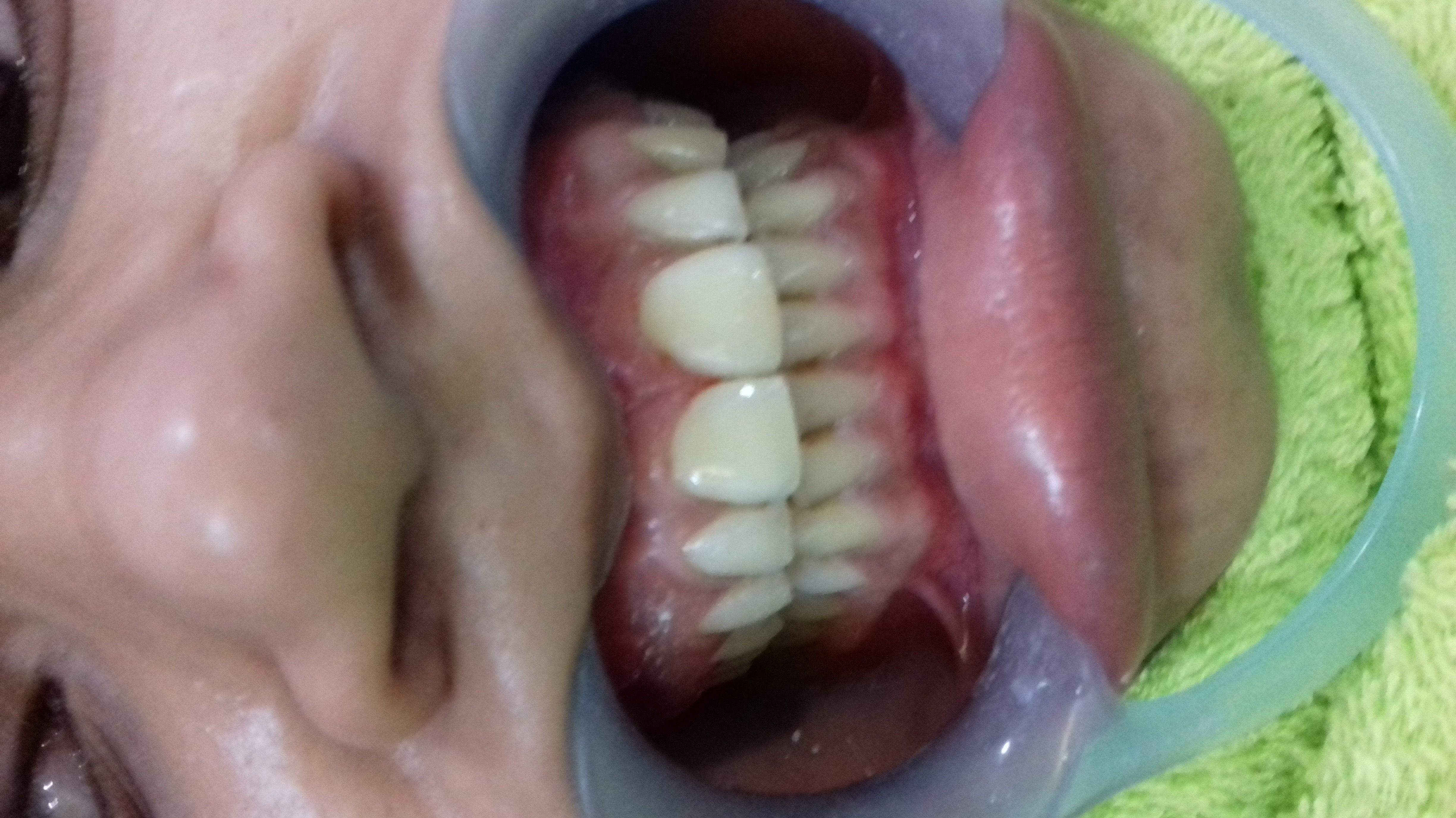 Dental Fillings