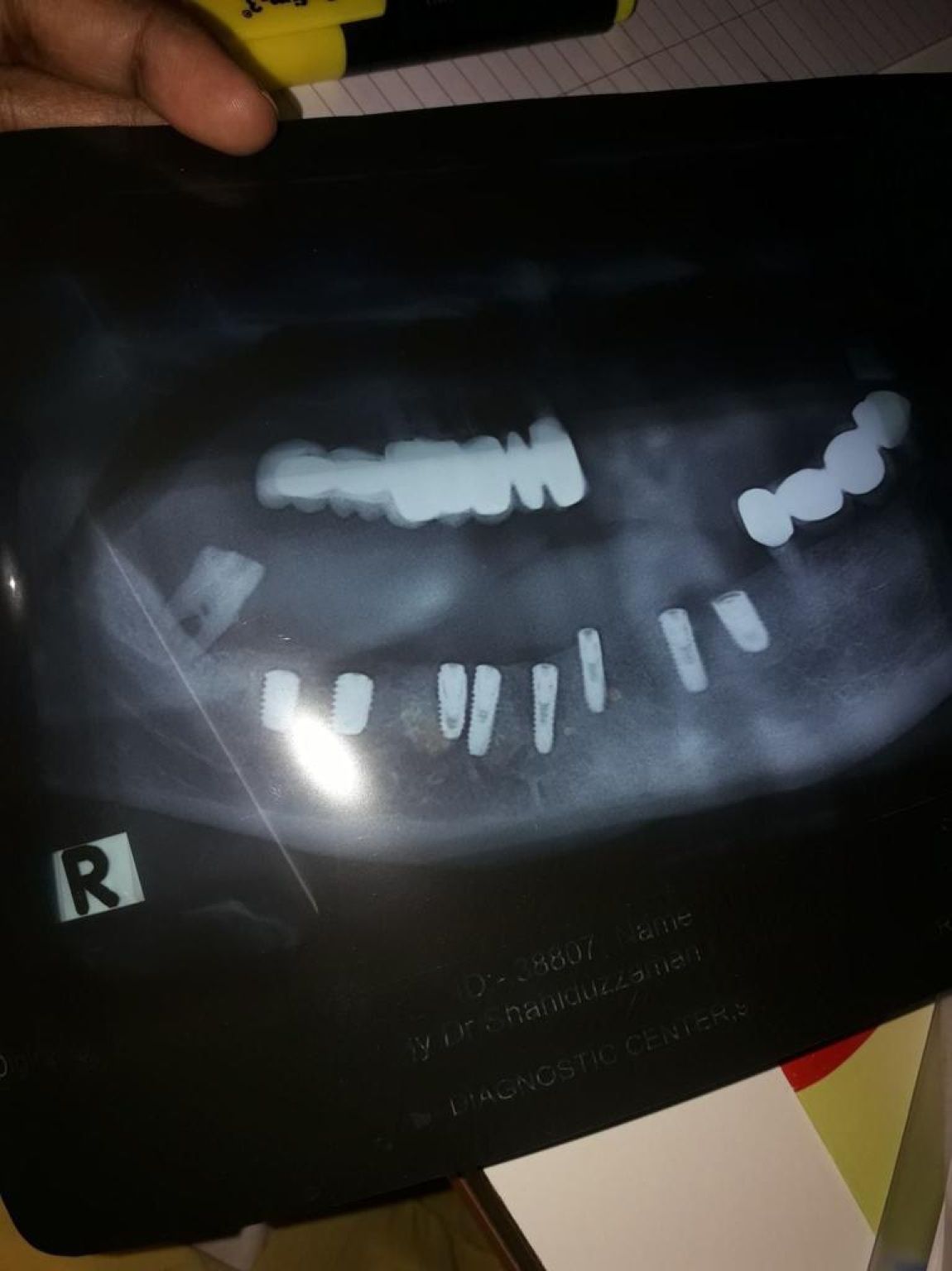 Implant image