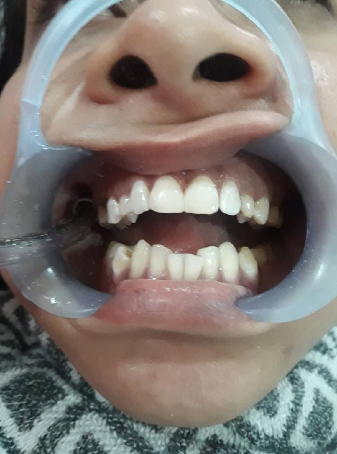 Dental Fillings