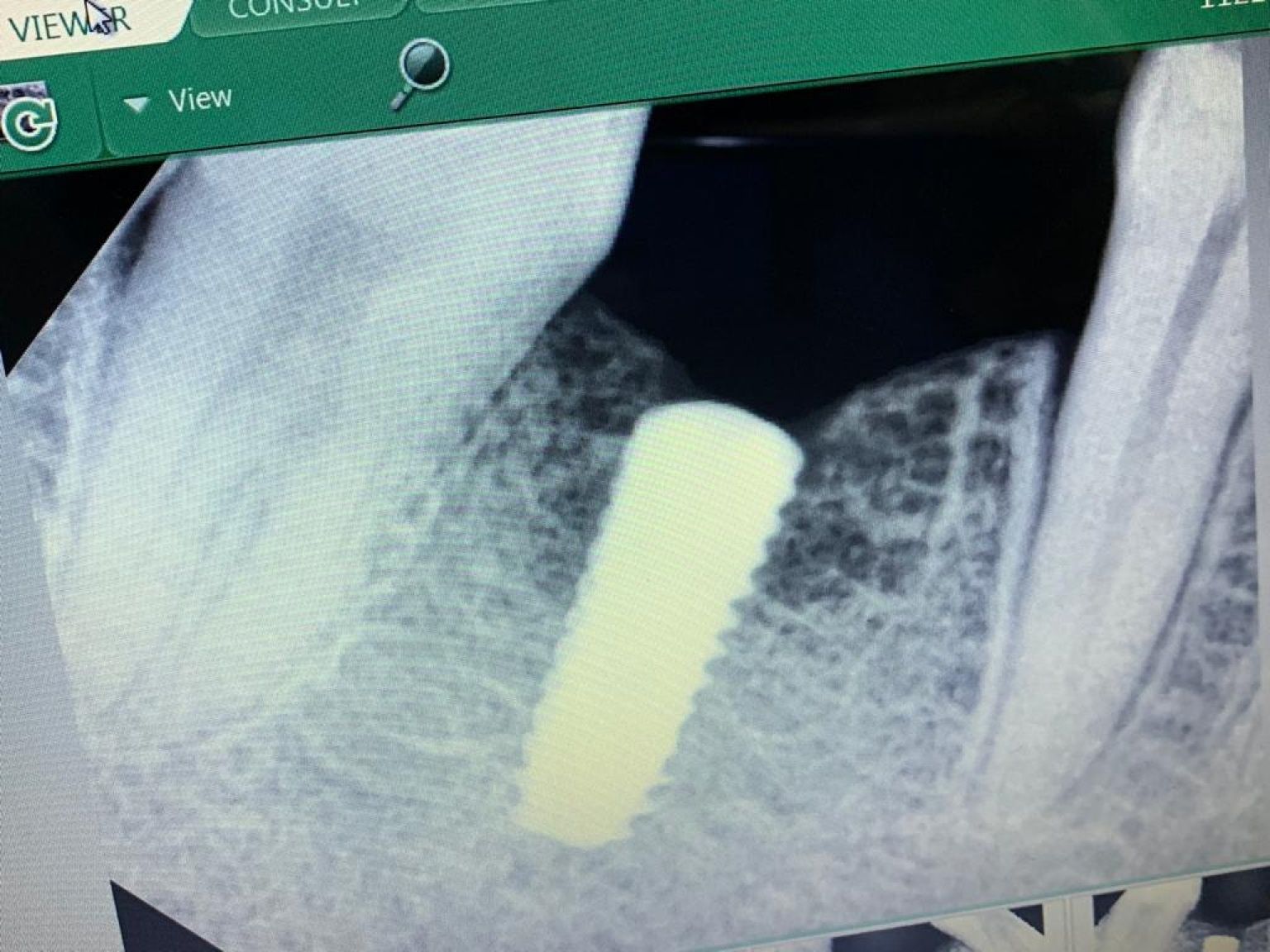Implant image