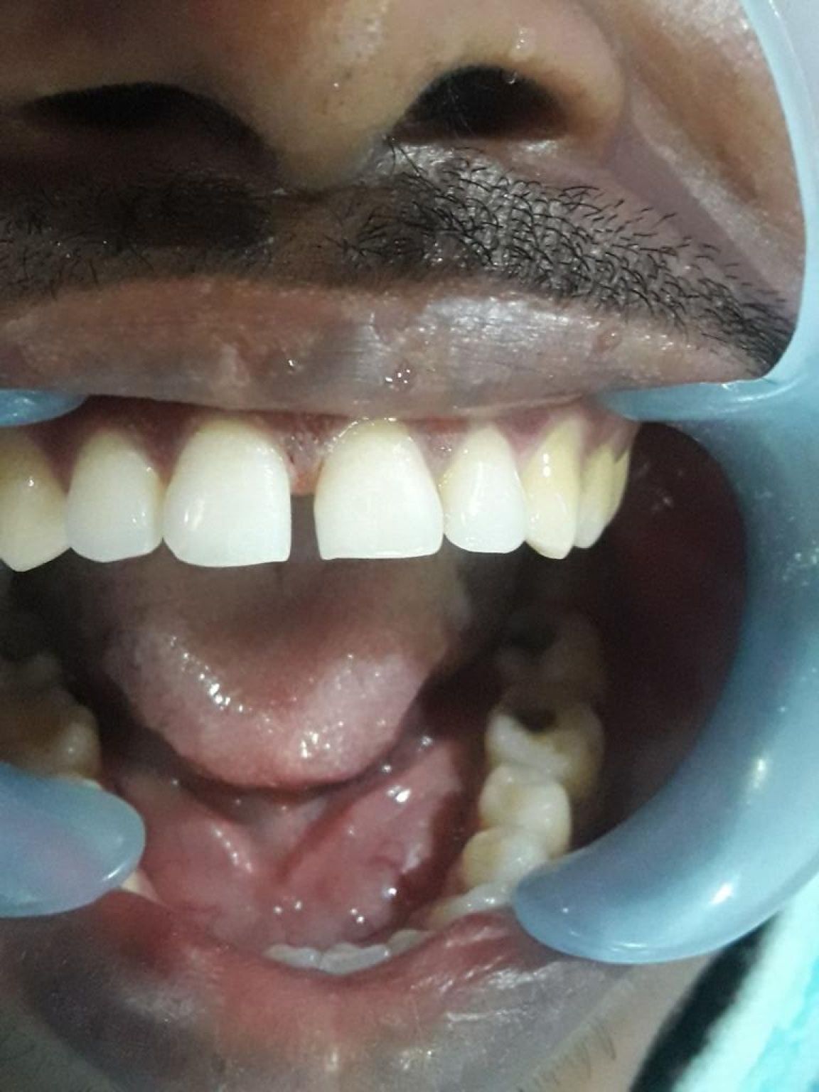 Dental Fillings