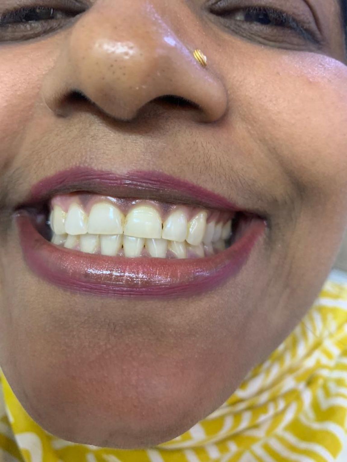 teeth whitening