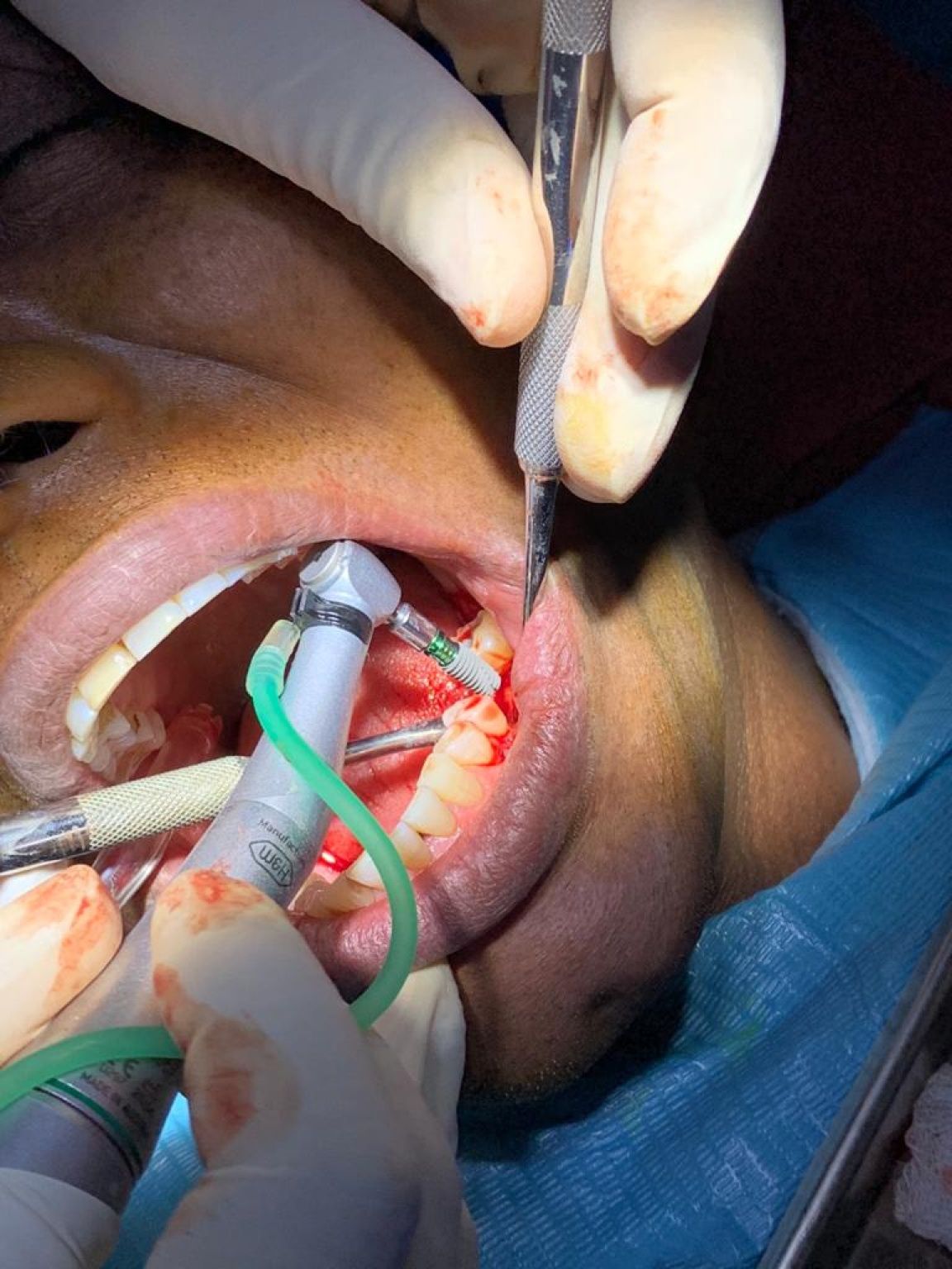 Implant image