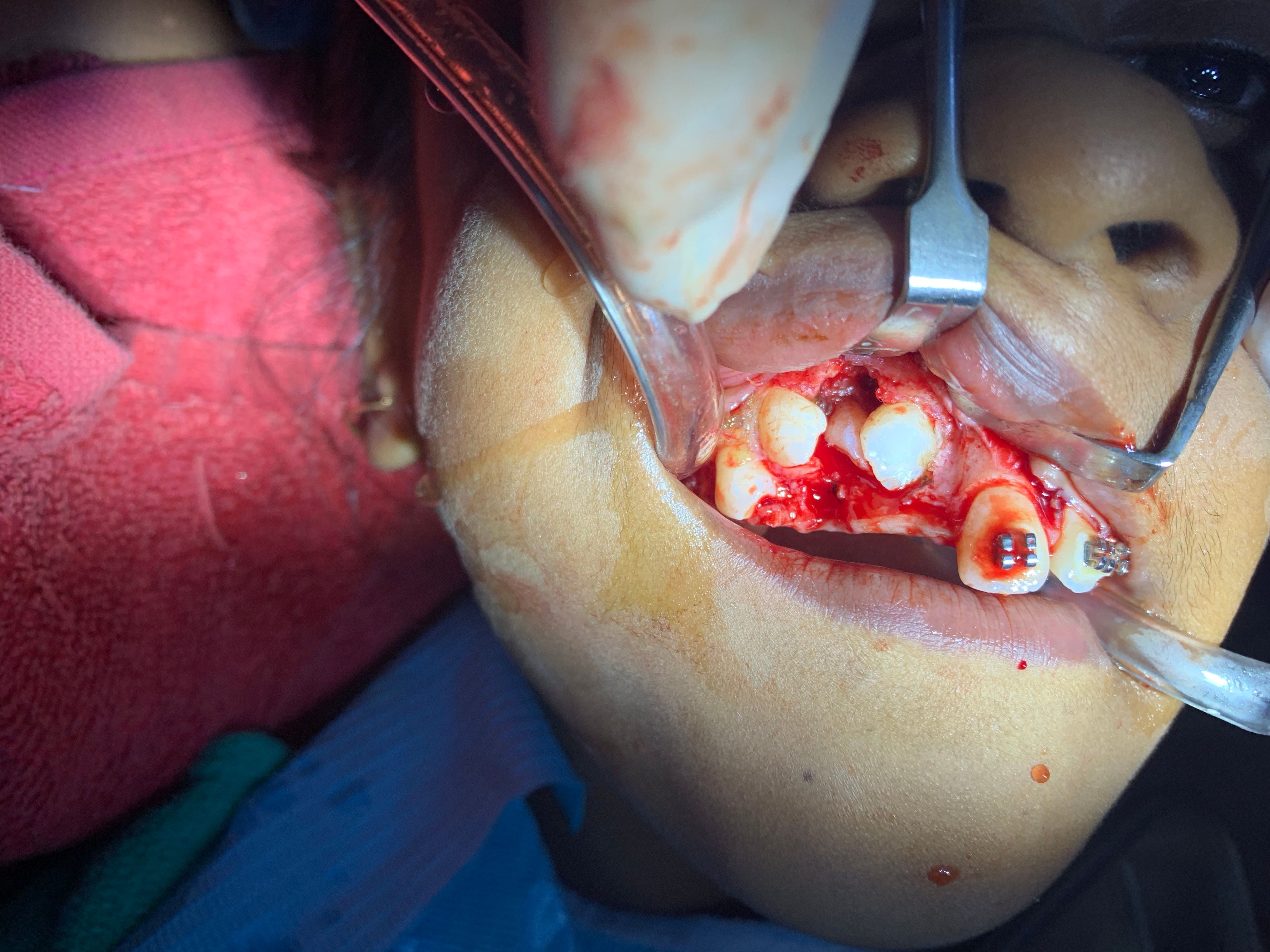 Orthodontic Treatment (Braces)