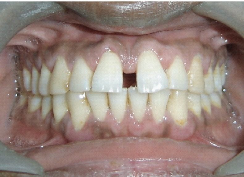 Dental Fillings