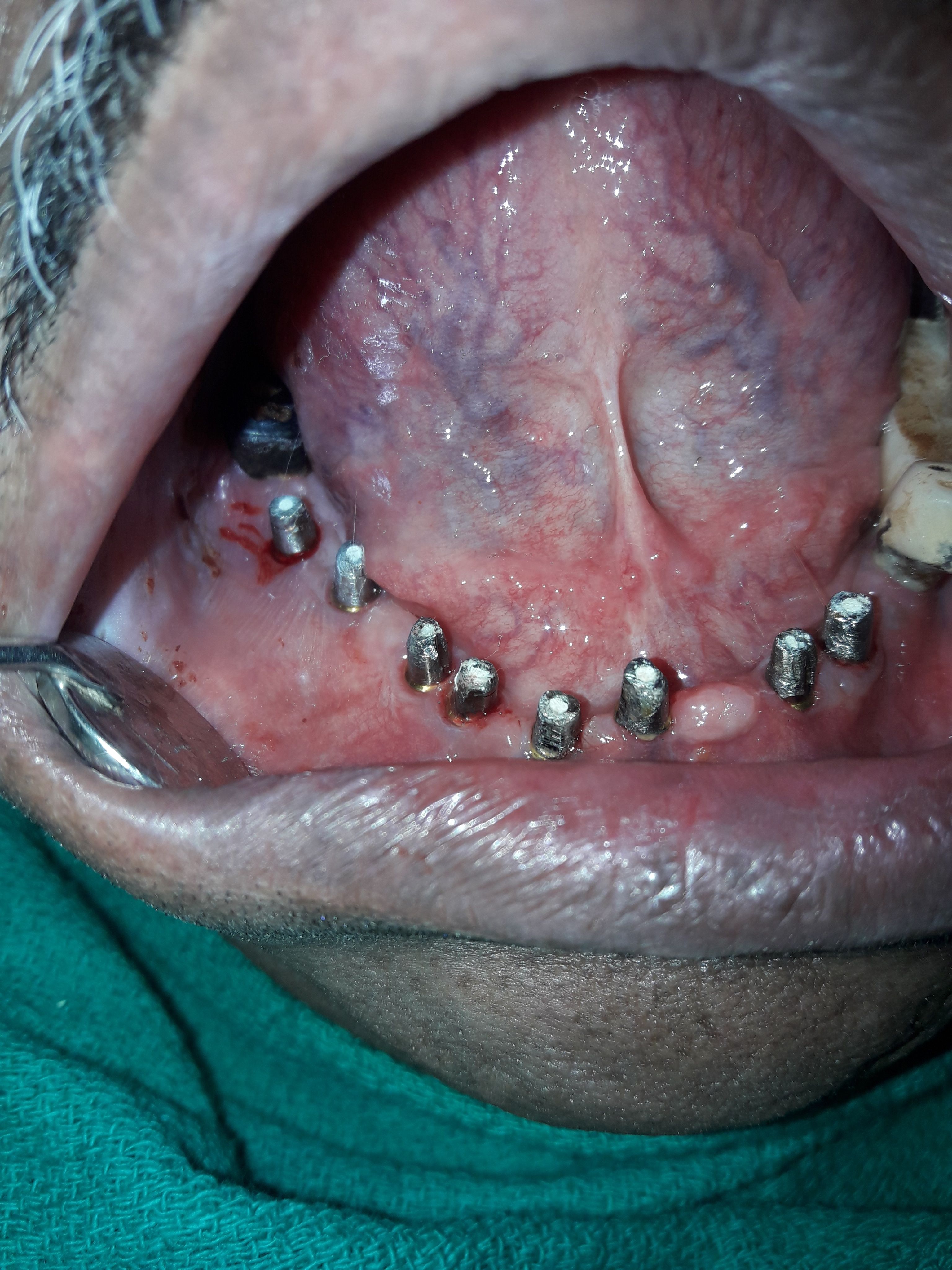 Implant image