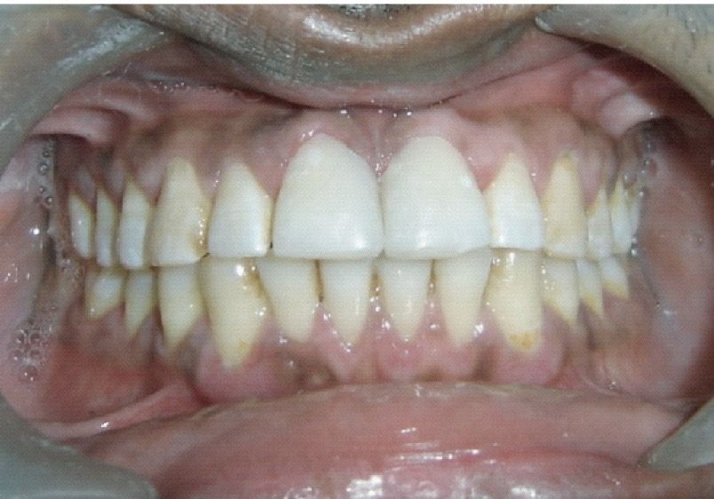 Dental Fillings