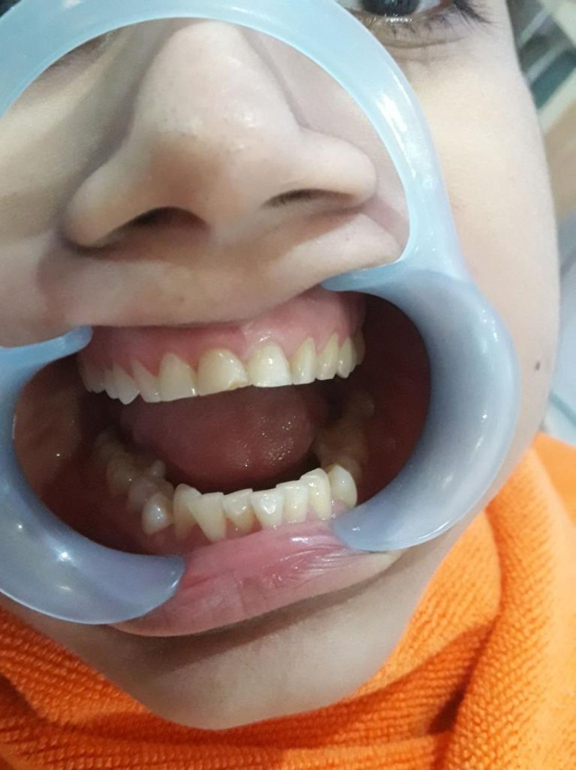 Dental Fillings