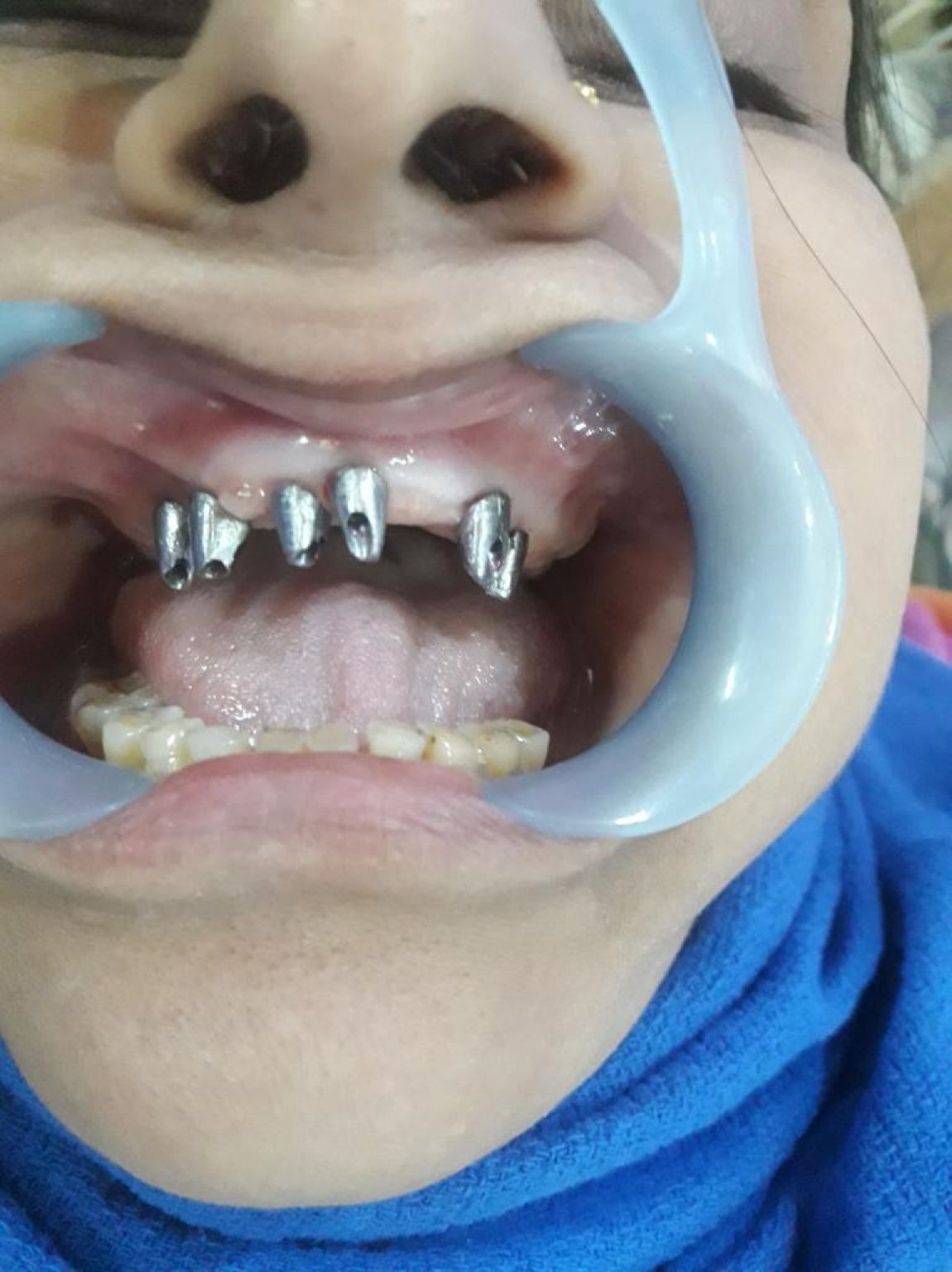 Implant image