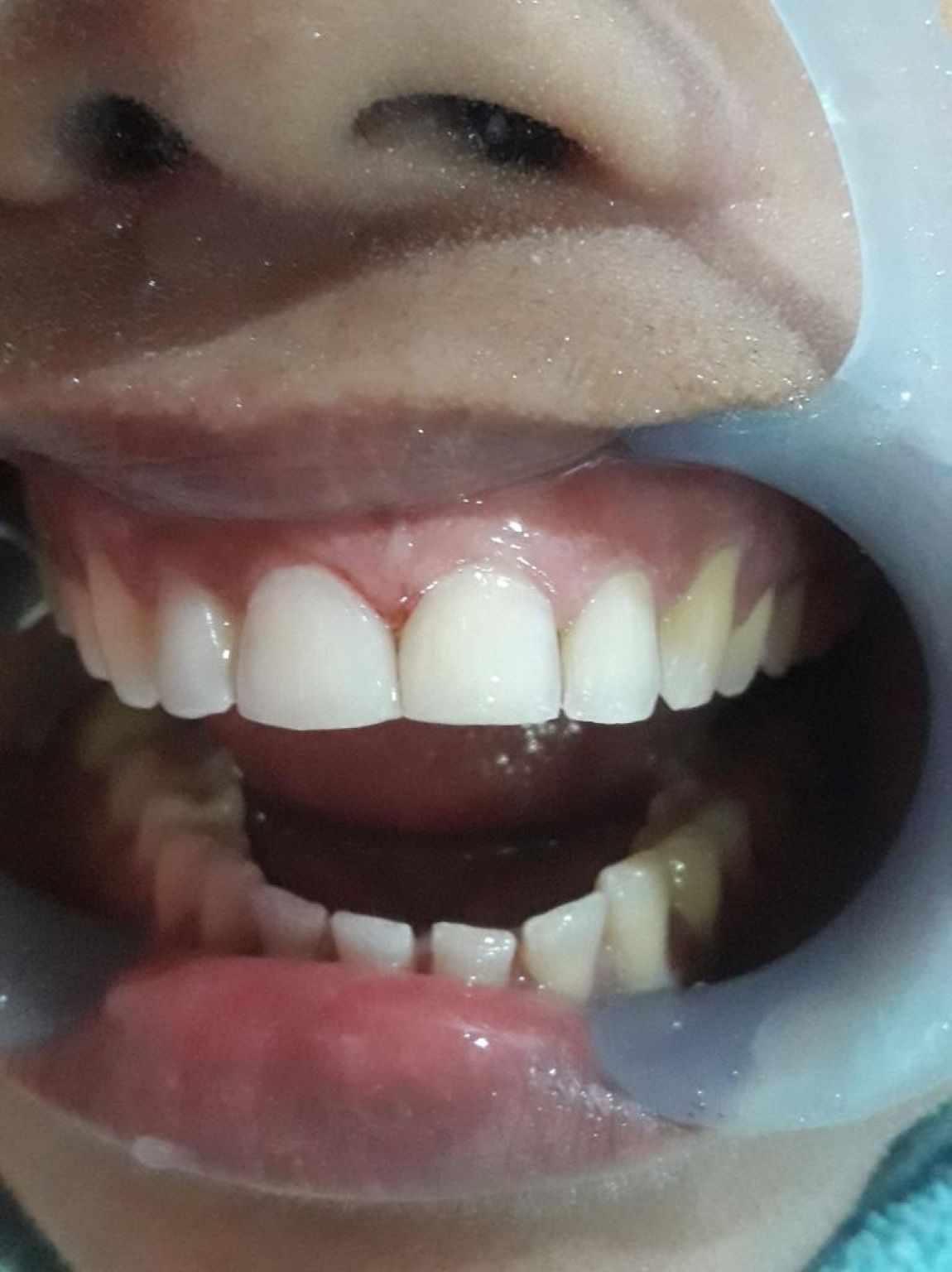 Dental Fillings