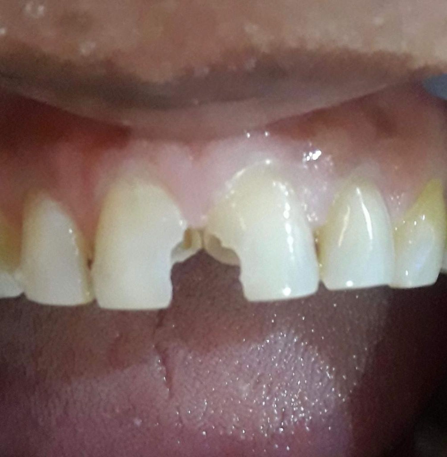 Dental Fillings